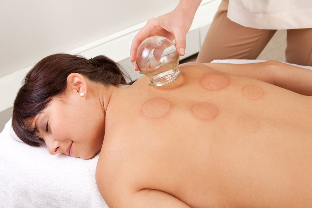 Edmistone Acupuncture & Chiropractic Facebook ad: Should You Try Cupping Therapy?