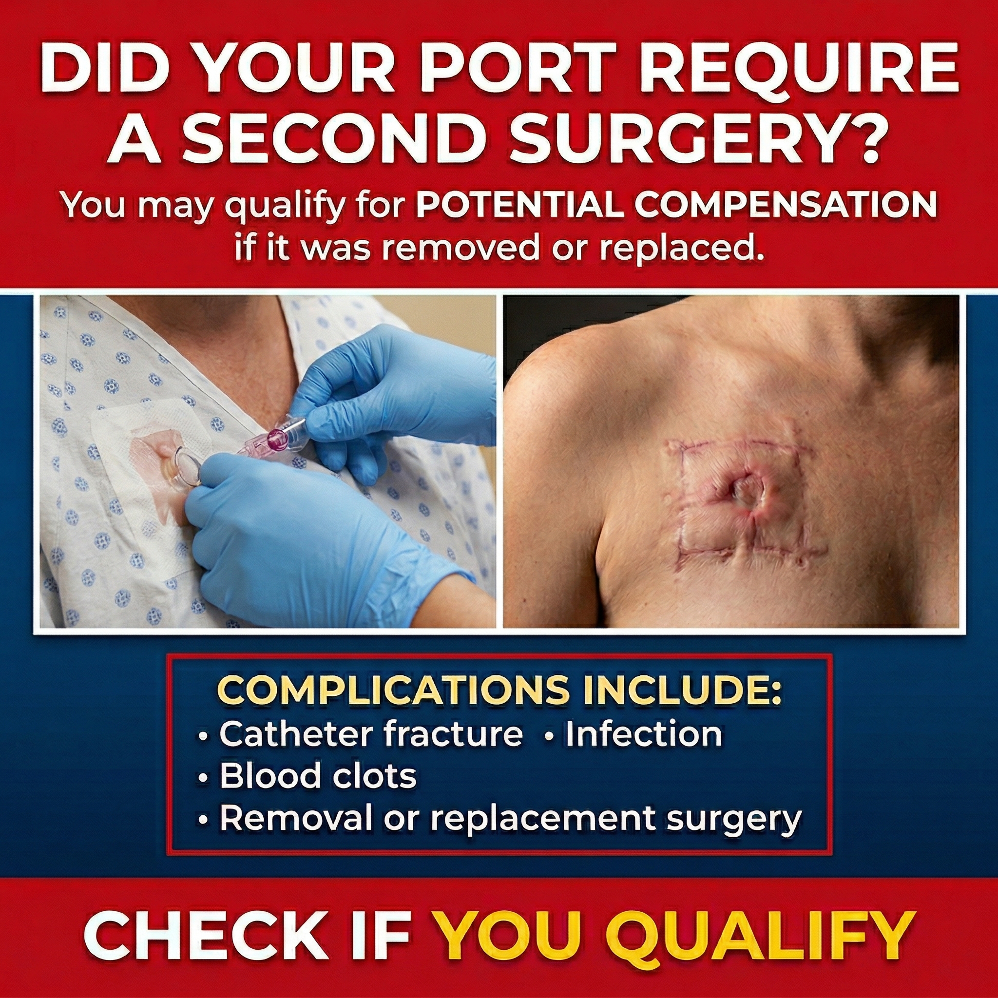 Settlement Finder Facebook ad: Port Catheter Issues? You May Be Eligible.