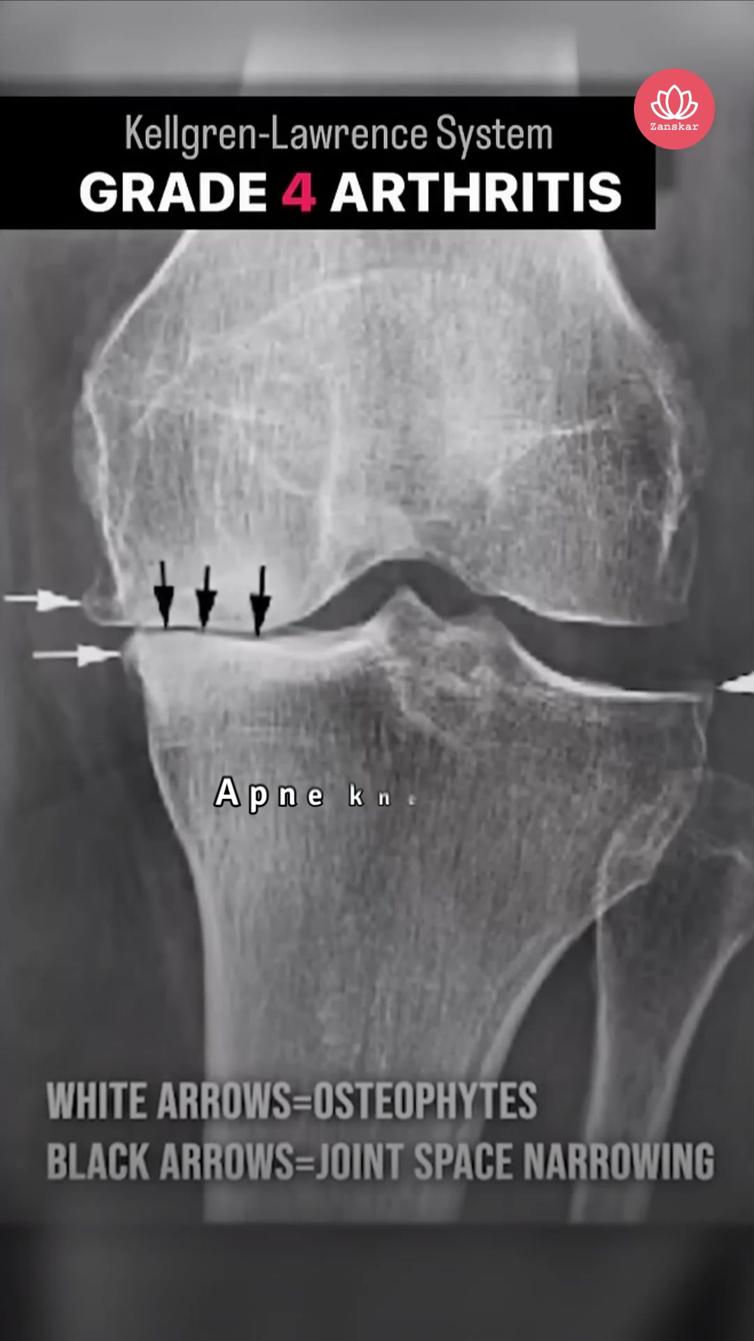 Zanskar: Muscle & Joint Relief Facebook ad: Rebuild Your Cartilage