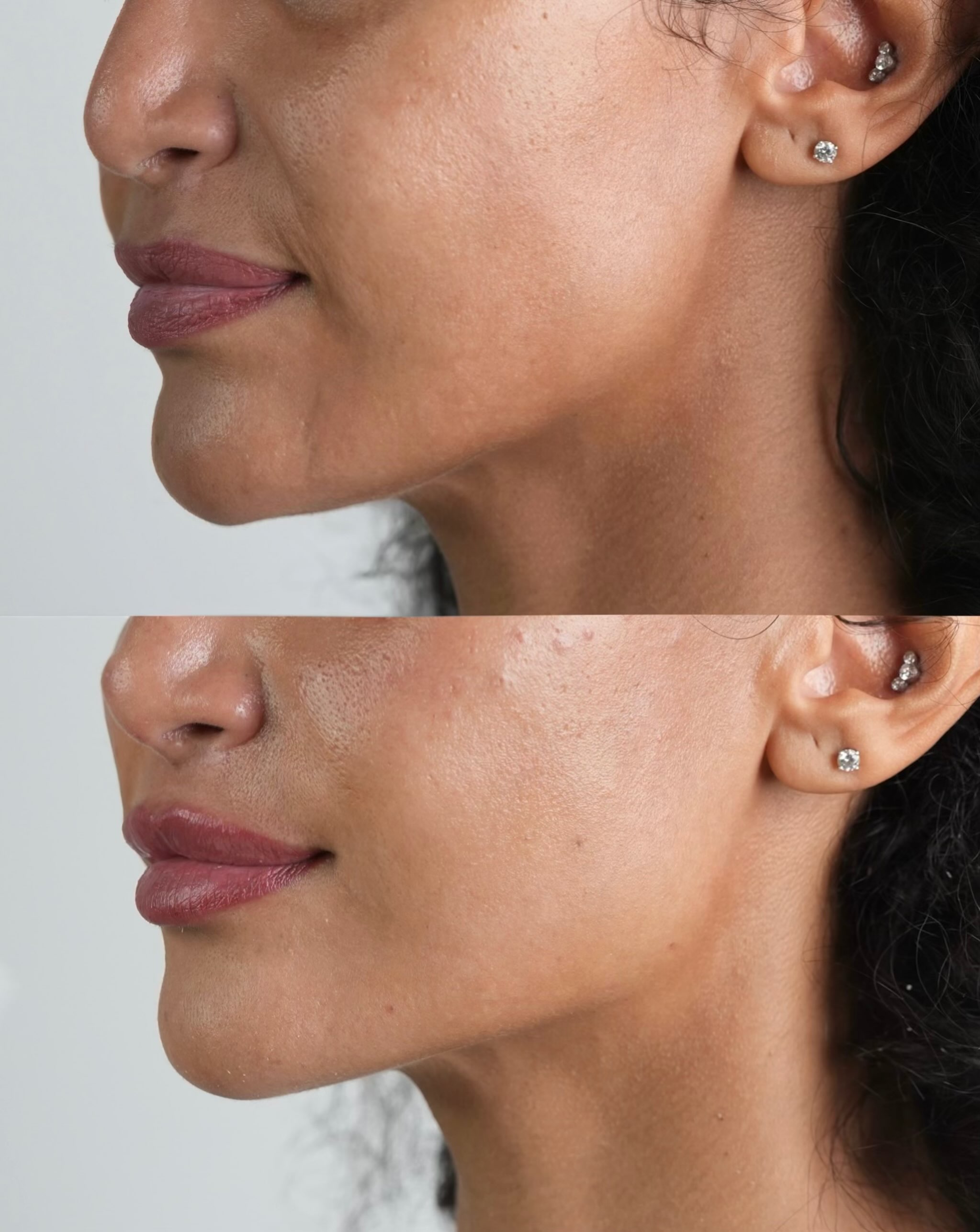 glosclinic Facebook ad: Natural looking rejuvenation rarely comes from using one…