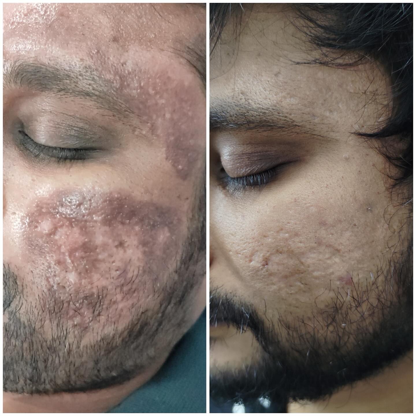 Transformance Facebook ad: Claim 35% Off Skin Treatments.Trusted by 5000+ Happy…
