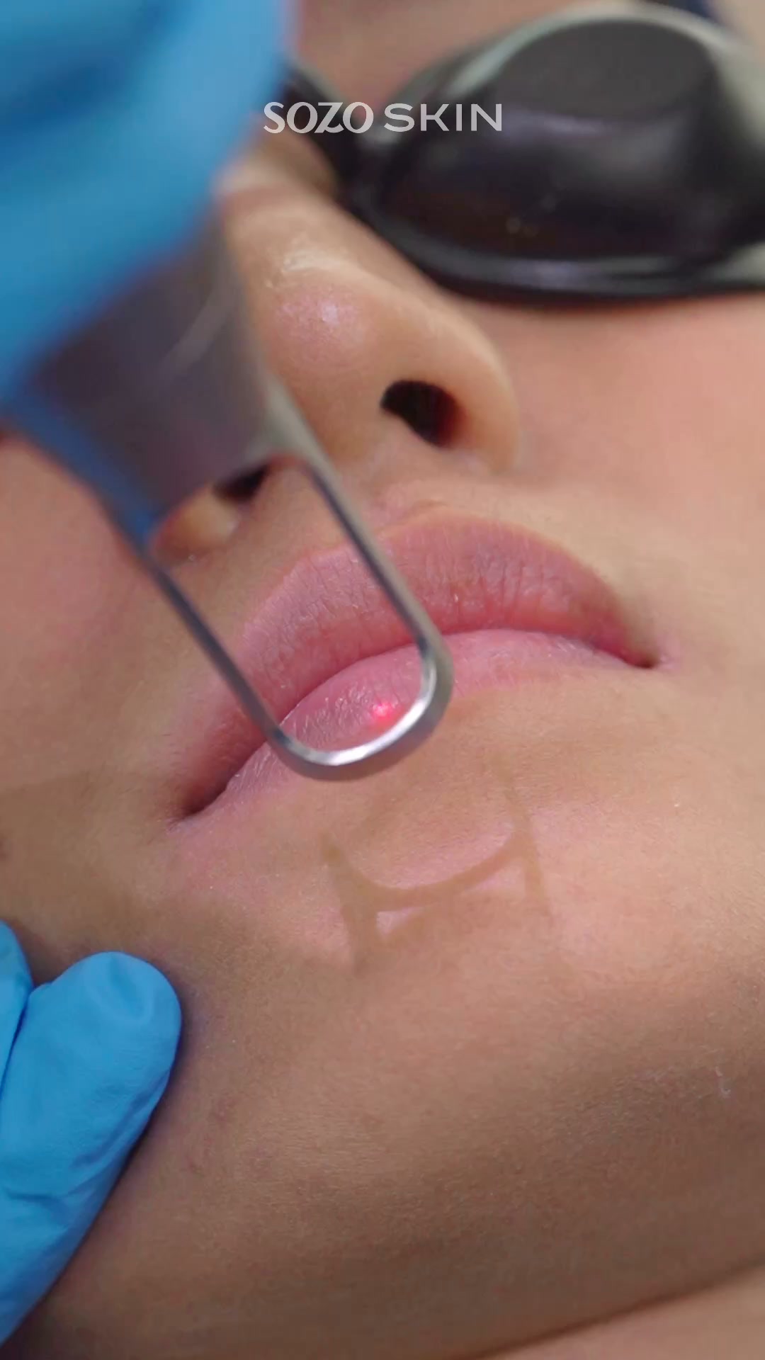 Sozo Skin Clinic Facebook ad: Promo Pink Lips Laser 199rb