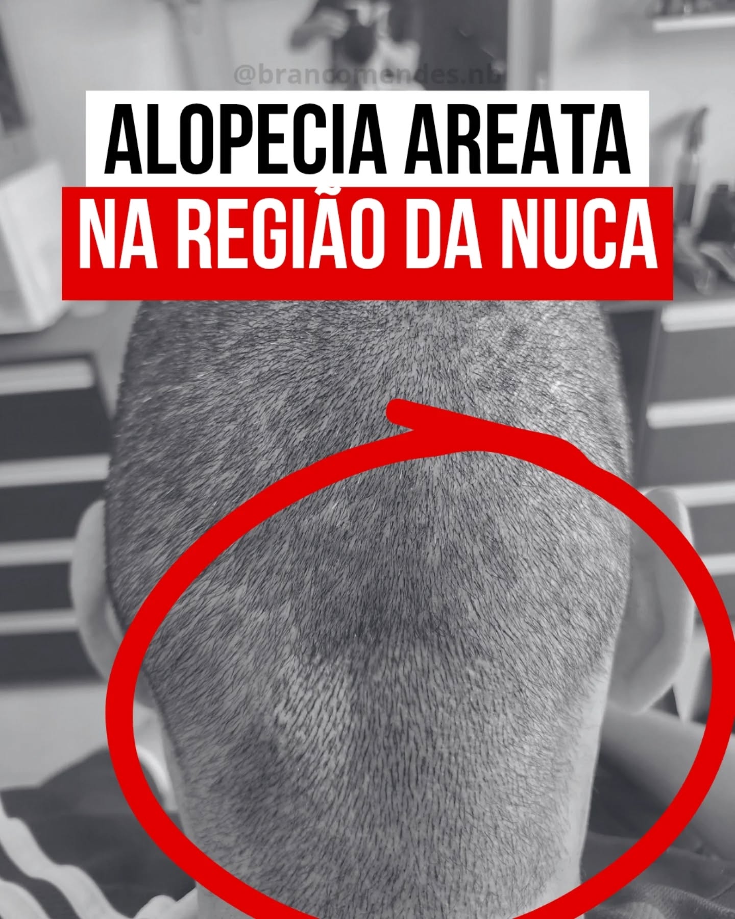 Espaço NB - Micropigmentação Capilar & Barbearia Facebook ad: Alopecia areata na nuca.