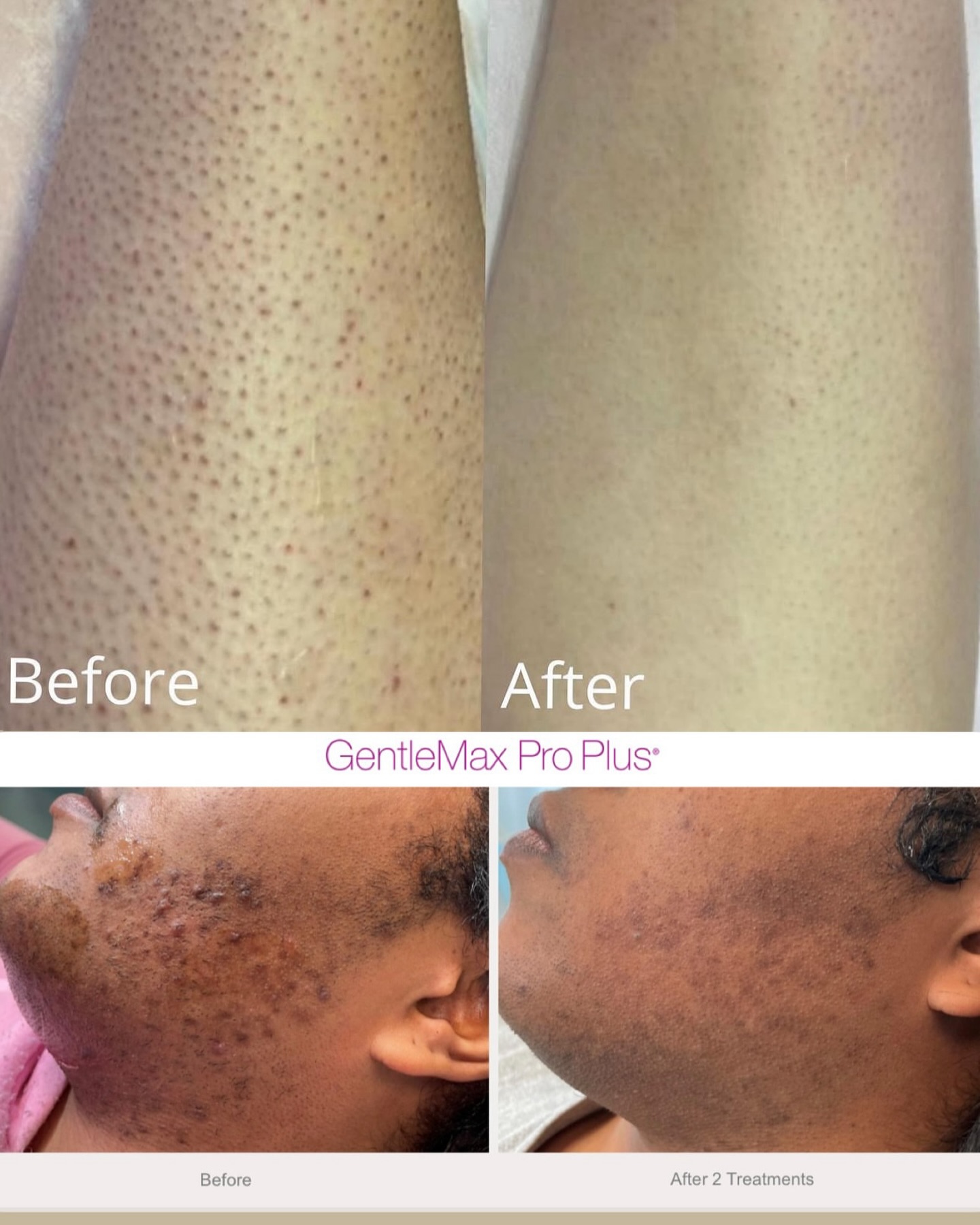 The Brow Bar 868 Facebook ad: Smooth skin starts here long-lasting results, no more…