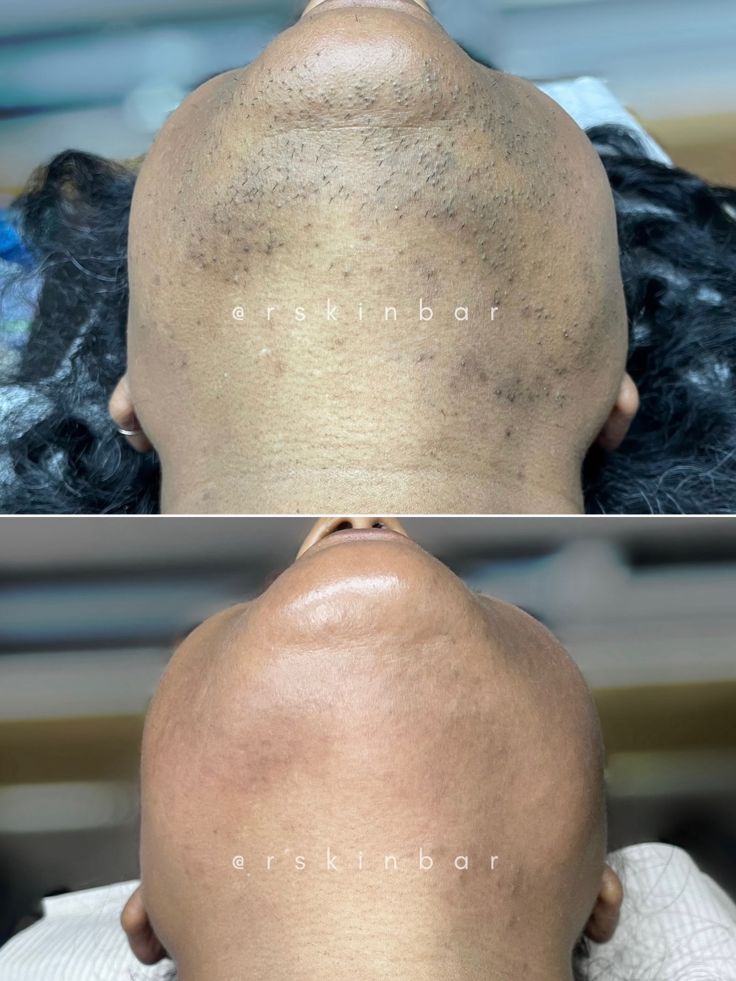 R Skin Bar Facebook ad: Aerolase Neo targets the root causes of ingrown…