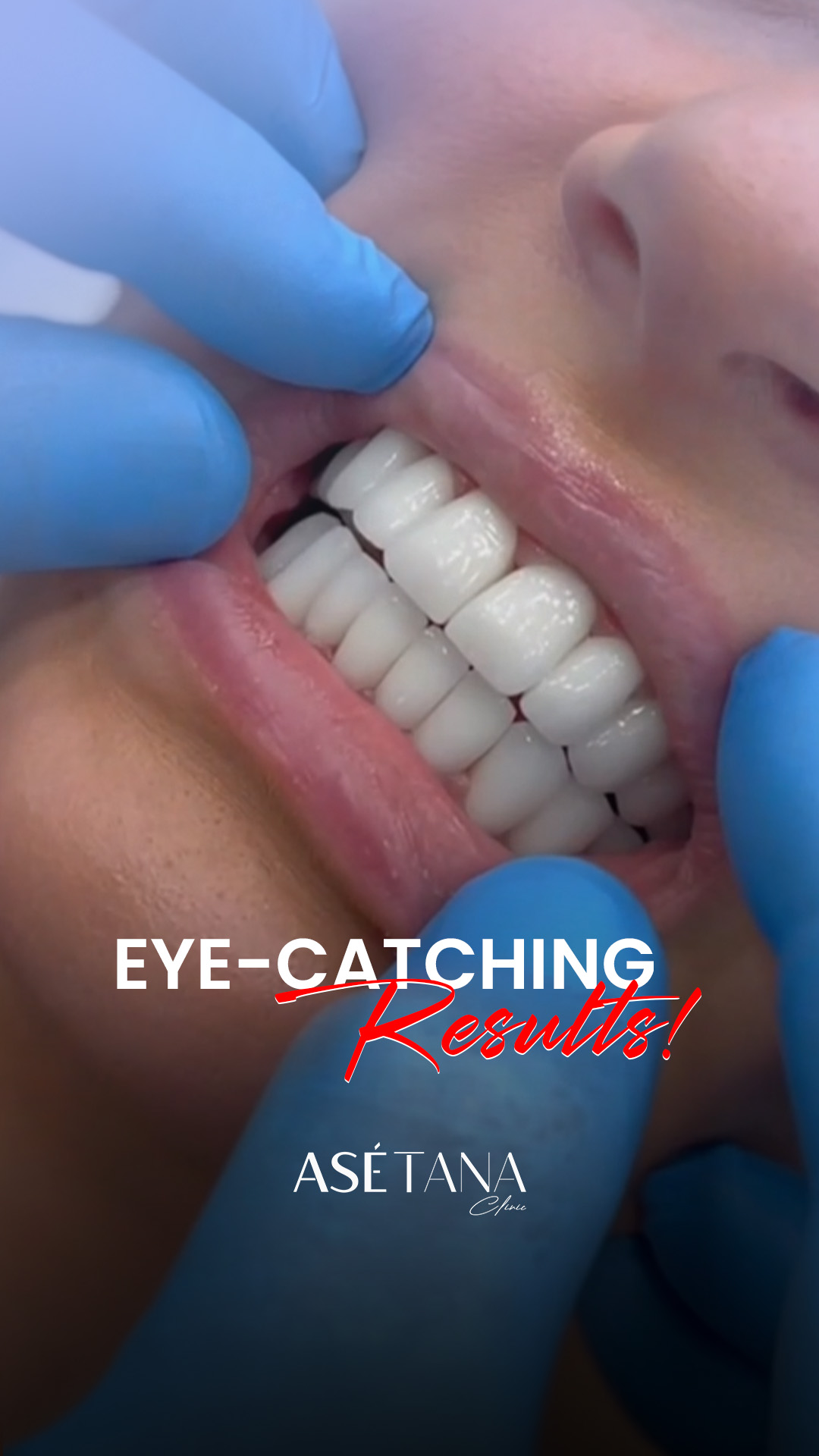 Asetana Clinic: Hollywood smile, Dental Implant, Teeth Veneers Facebook ad: Free Consultation: Regain Your Smile Confidence
