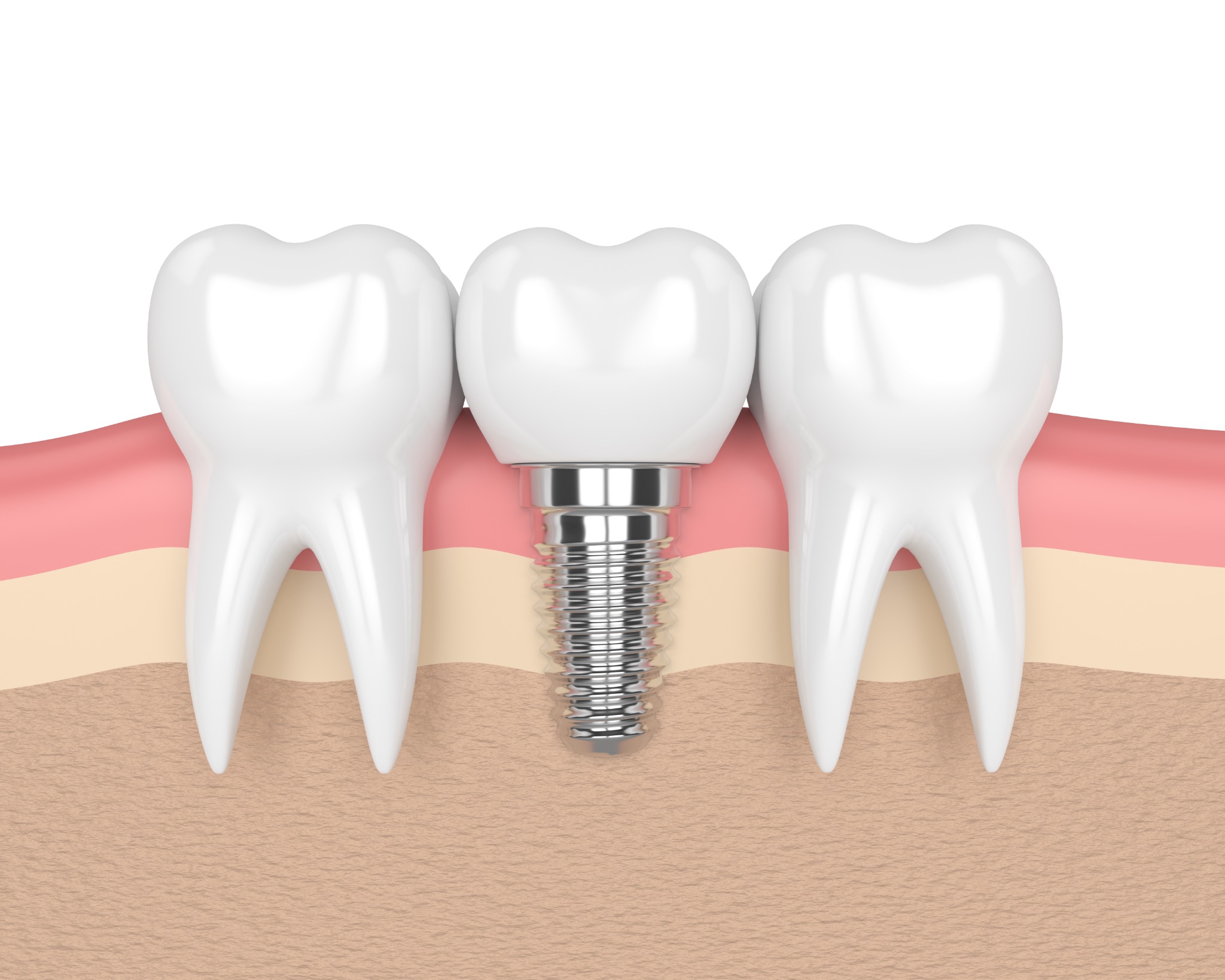 Platinum Dental Facebook ad: Get a dental implant consultation today.