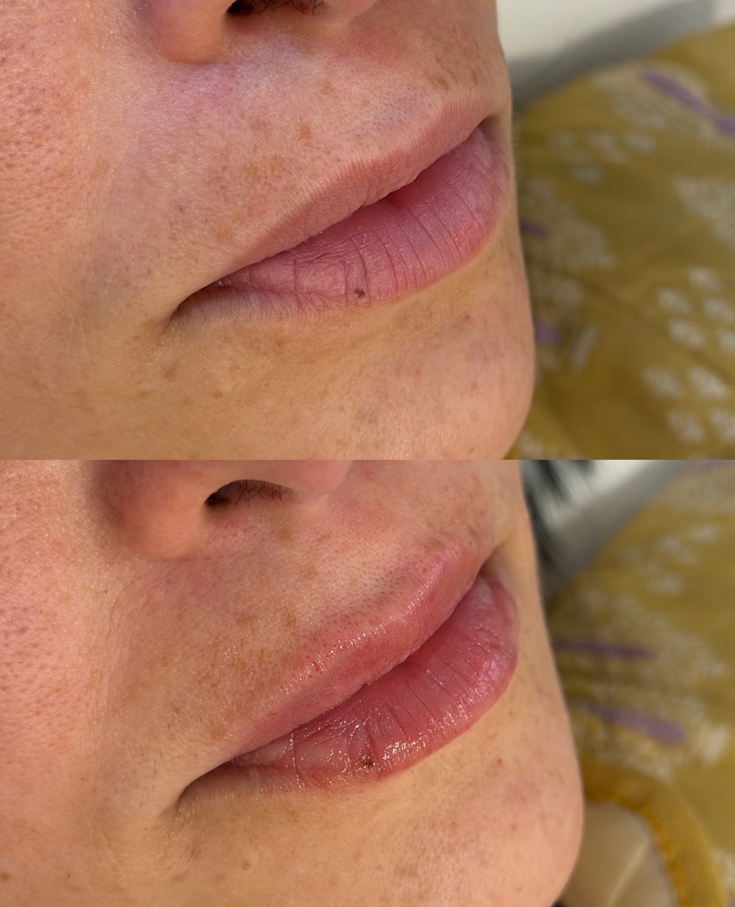Dra. Karina Yaroshova Facebook ad: Lunes de Aumento de Labios