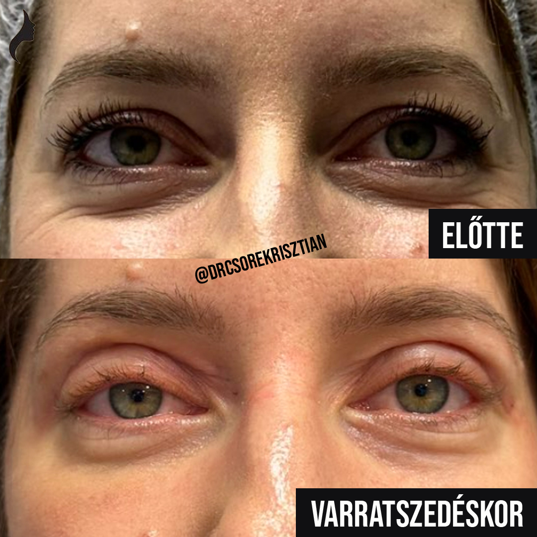 Dr. Csőre Krisztián - Plasztikai Sebész Facebook ad: Felső szemhéjplasztikai beavatkozás után, akár 5-10 évet is…