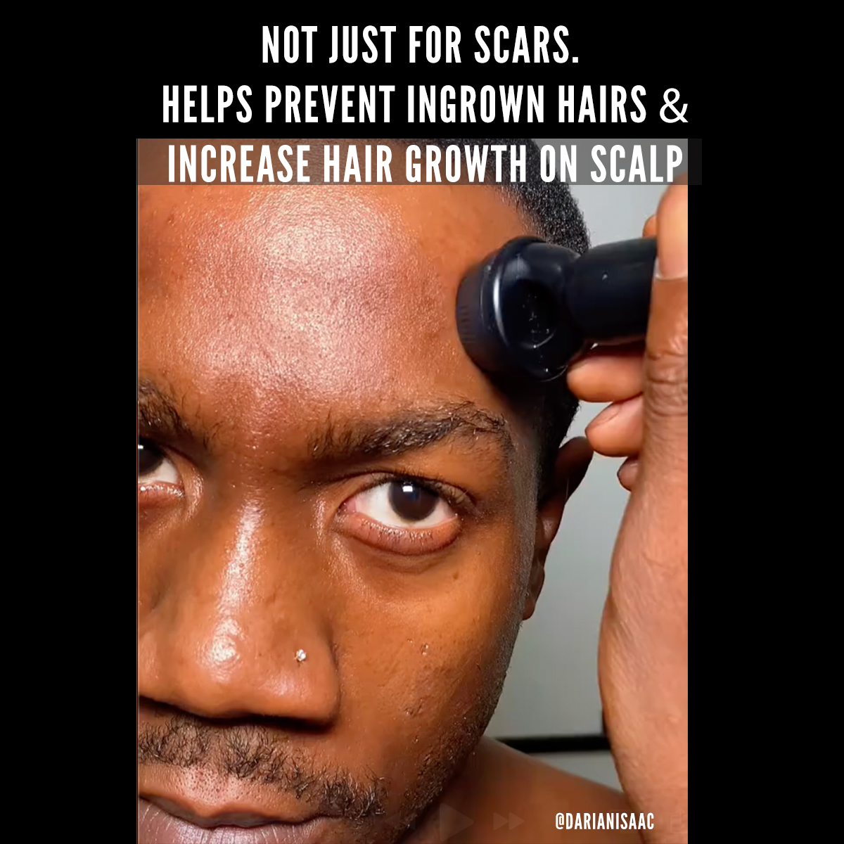 Banish Acne Scars Facebook ad