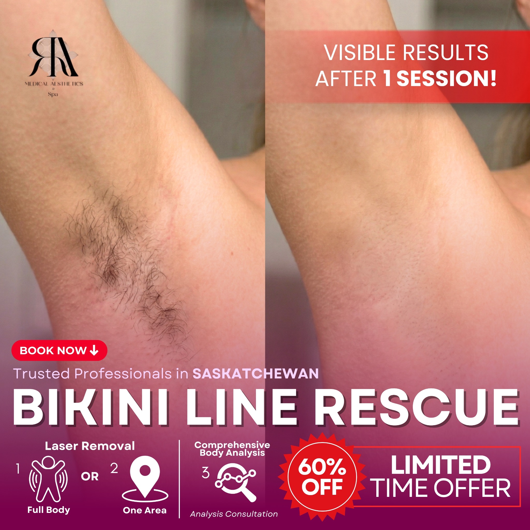 RA Medical Aesthetics & Spa Facebook ad: 60% OFF | Bikini Line Makeover