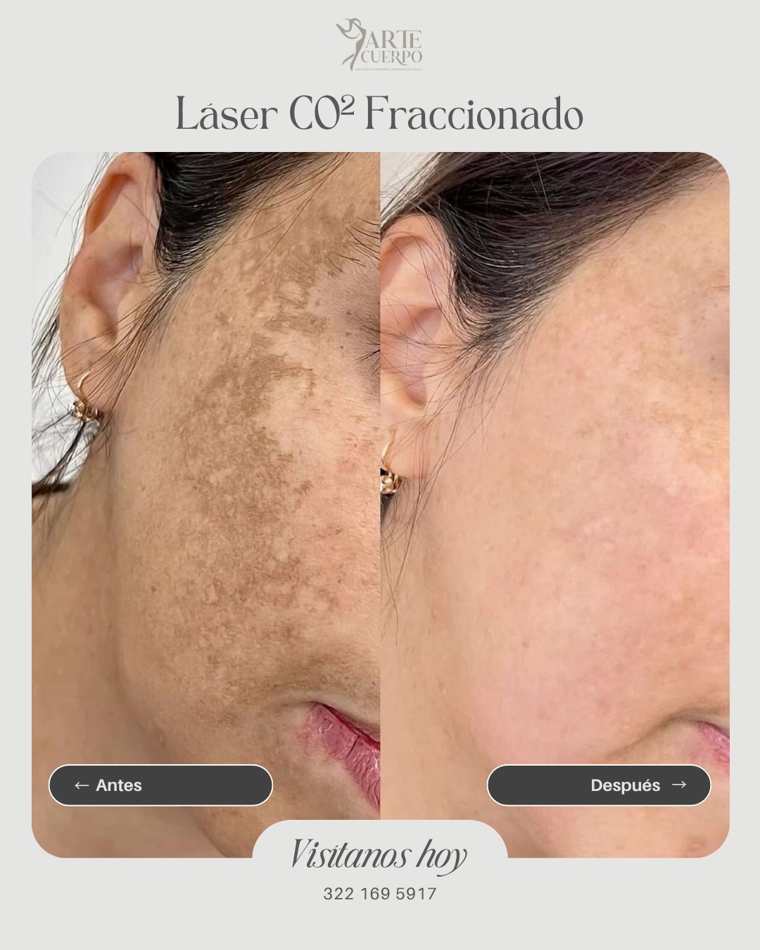 Arte Cuerpo Clinica Vallarta Facebook ad: Resultados que renuevan tu piel desde adentro.