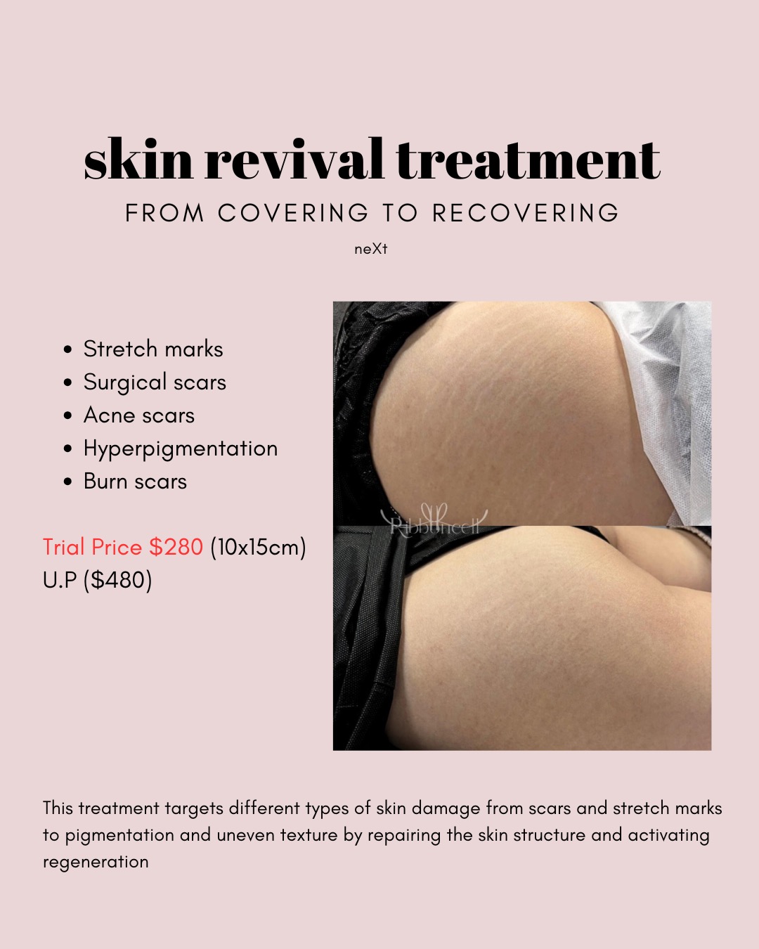 Next 1st Korea Scalp Micro-Pigmentation Facebook ad: One year from now, you'll thank yourself for…
