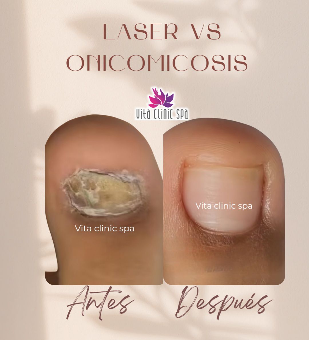 Spa Vita clínic Facebook ad: Uñas limpias, sanas y libres de hongos… ¡sin…