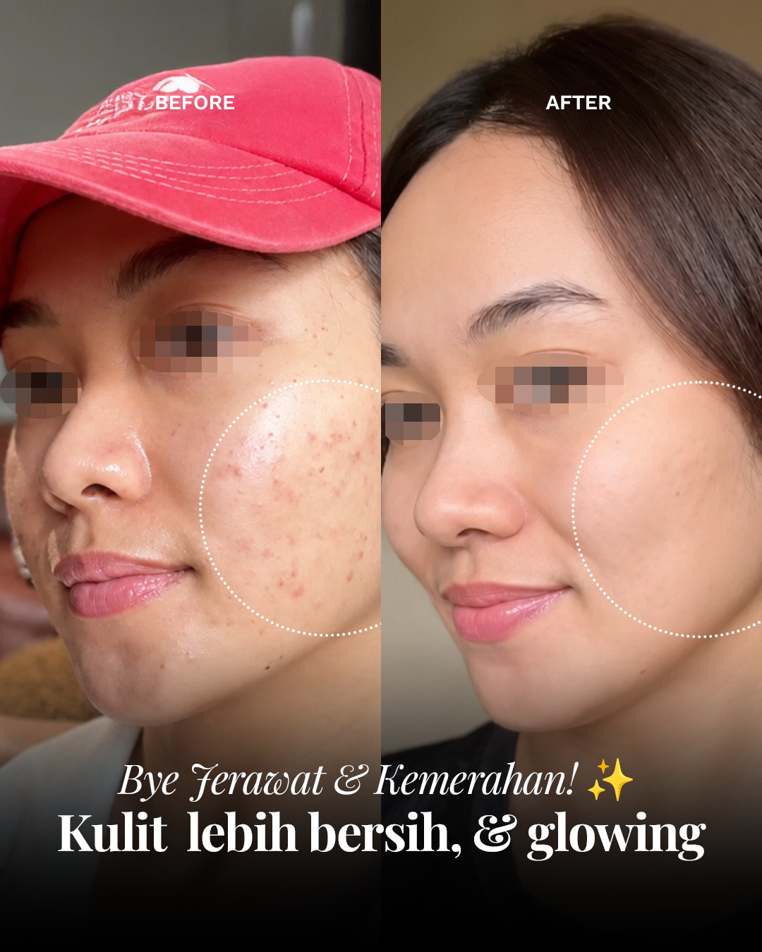 Elsheskinclinic Facebook ad: Jerawat meradang + bekas kemerahan sering bikin kulit…