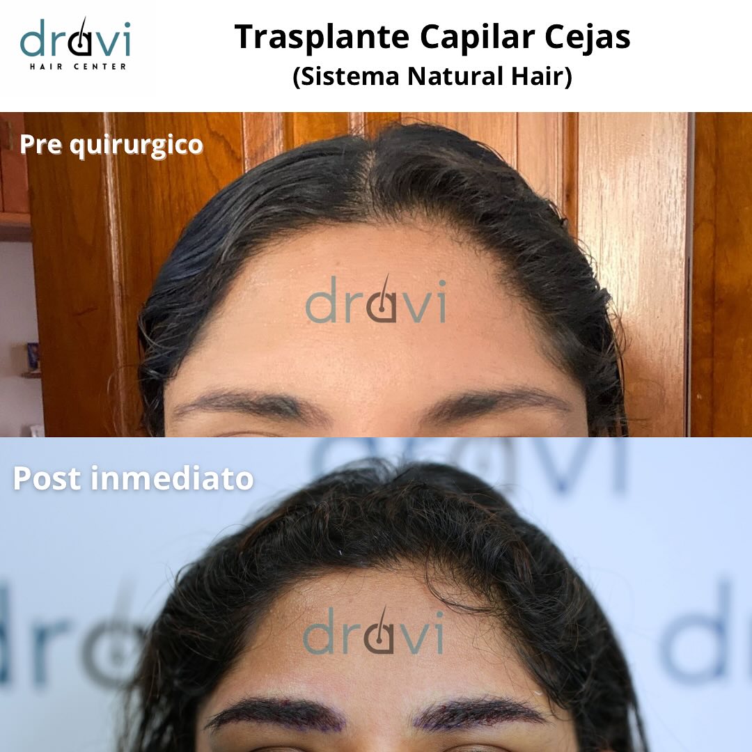 DRAVI Centro de Trasplante Capilar Facebook ad: TESTIMONIOS REALES ( Pre Quirúrgico - Post Inmediato…