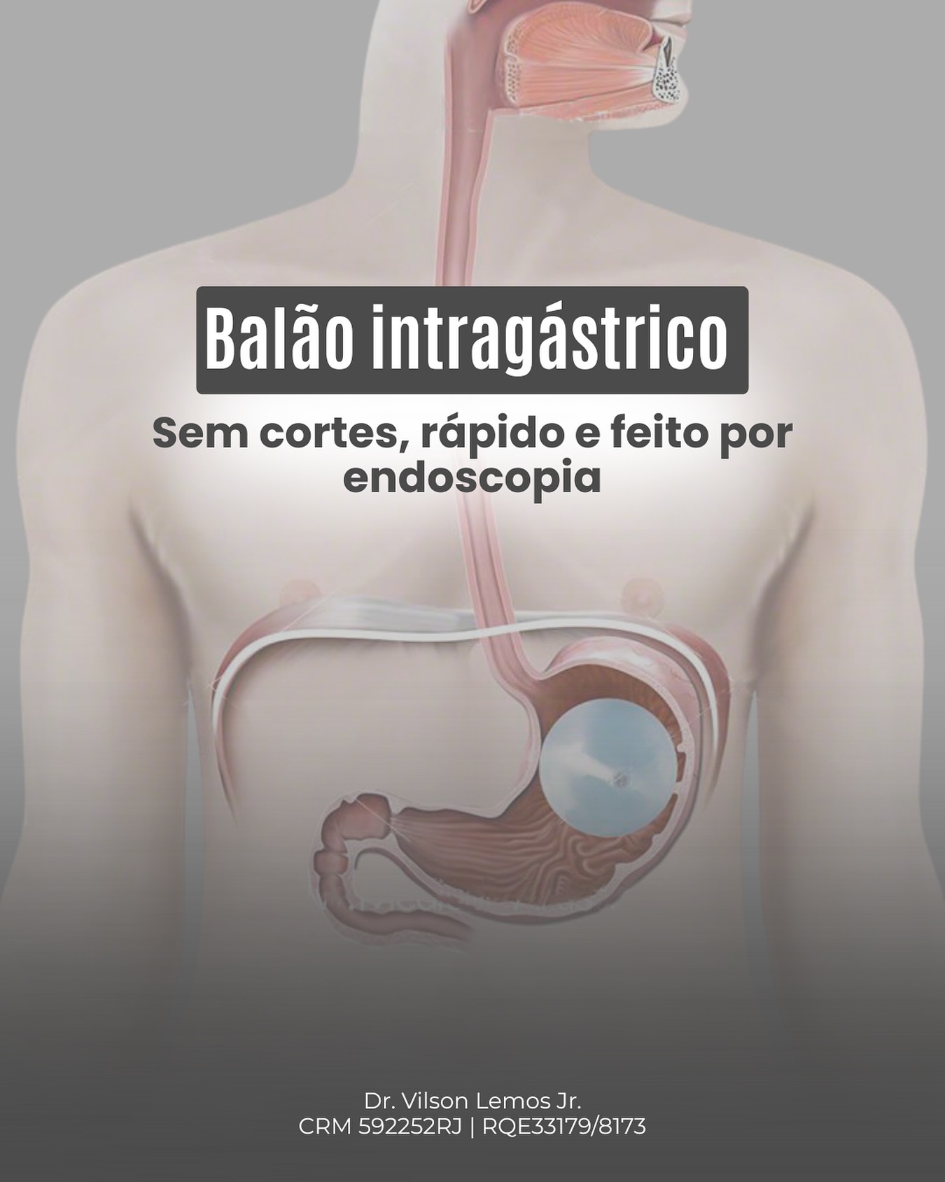 Dr. Vilson Lemos Jr Facebook ad: O balão intragástrico é uma alternativa segura, sem…