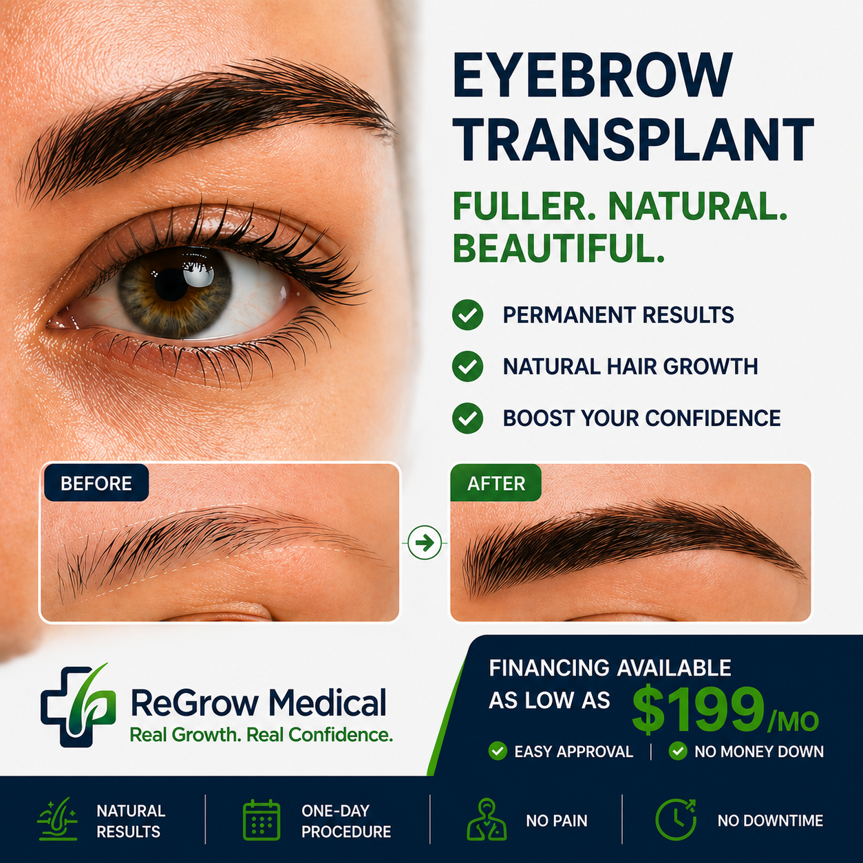 ReGrow Medical Facebook ad: FUE Eyebrow Transplant, Permanent. Natural. One Day.