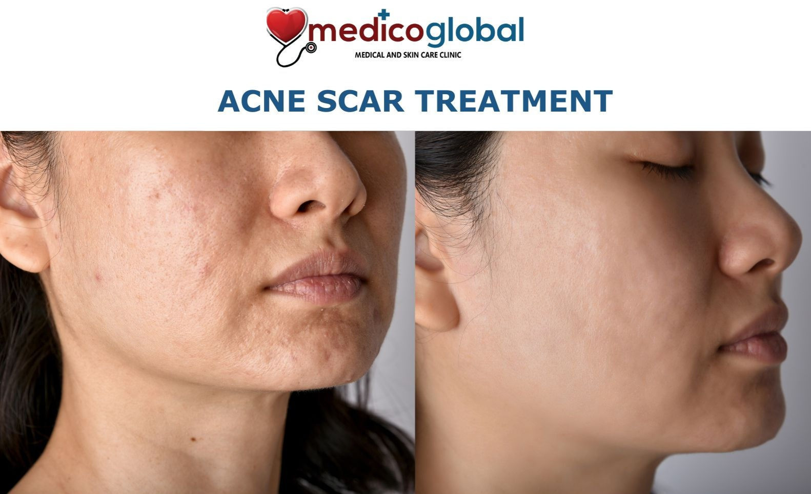 Medico Global Clinic - GH Mall Greenhills San Juan Facebook ad: Medico Global Clinic Manila / CO2 Fractional Laser for…