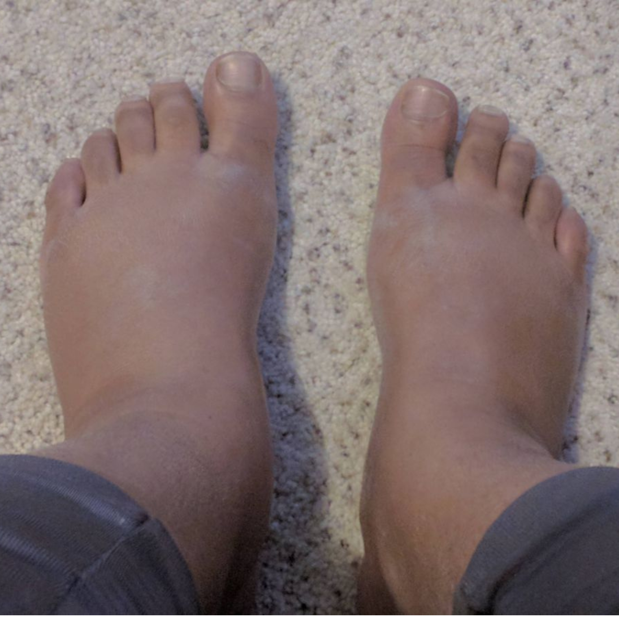 American Foot Association - AFA Facebook ad: New study: 70 million Americans have swollen ankles. but…