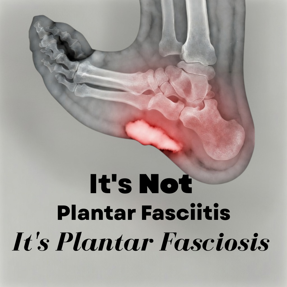 The Modern Facebook ad: HEEL PAIN? ITS NOT PLANTAR FASCIITIS.