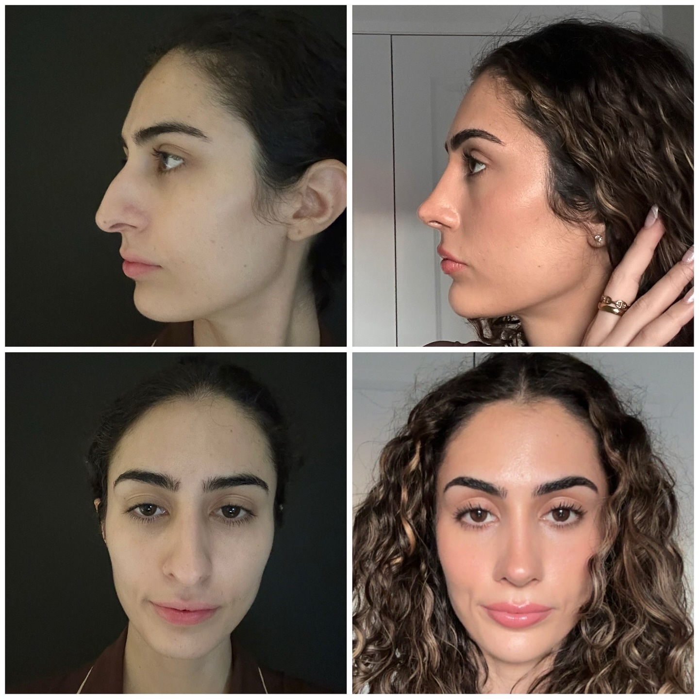 Op Dr Baver M. Şimşek Facebook ad: My beautiful patient made her before and after…
