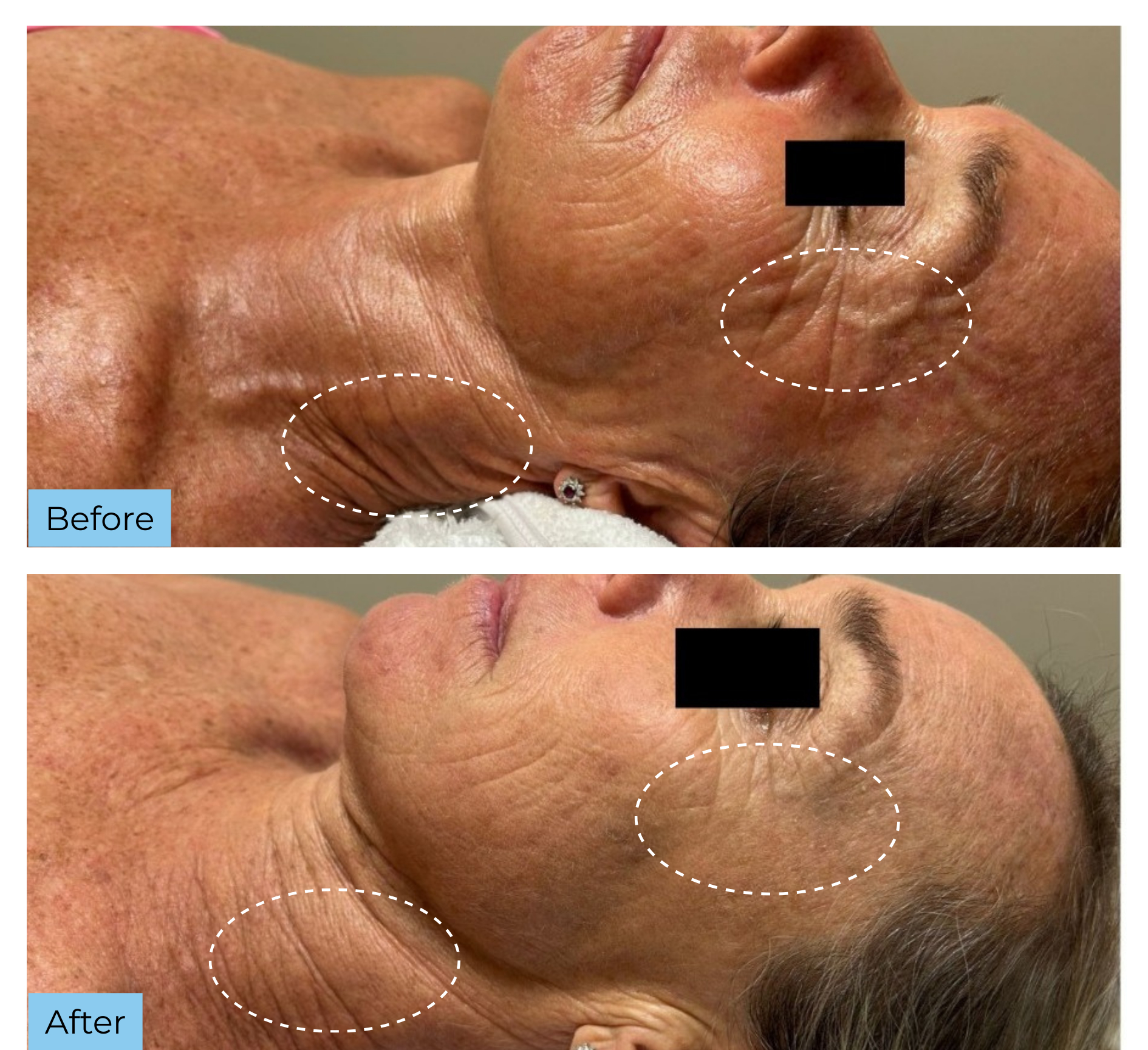 Dermafix Spa Sarasota Facebook ad: Sarasota’s $99 Dermalift Special