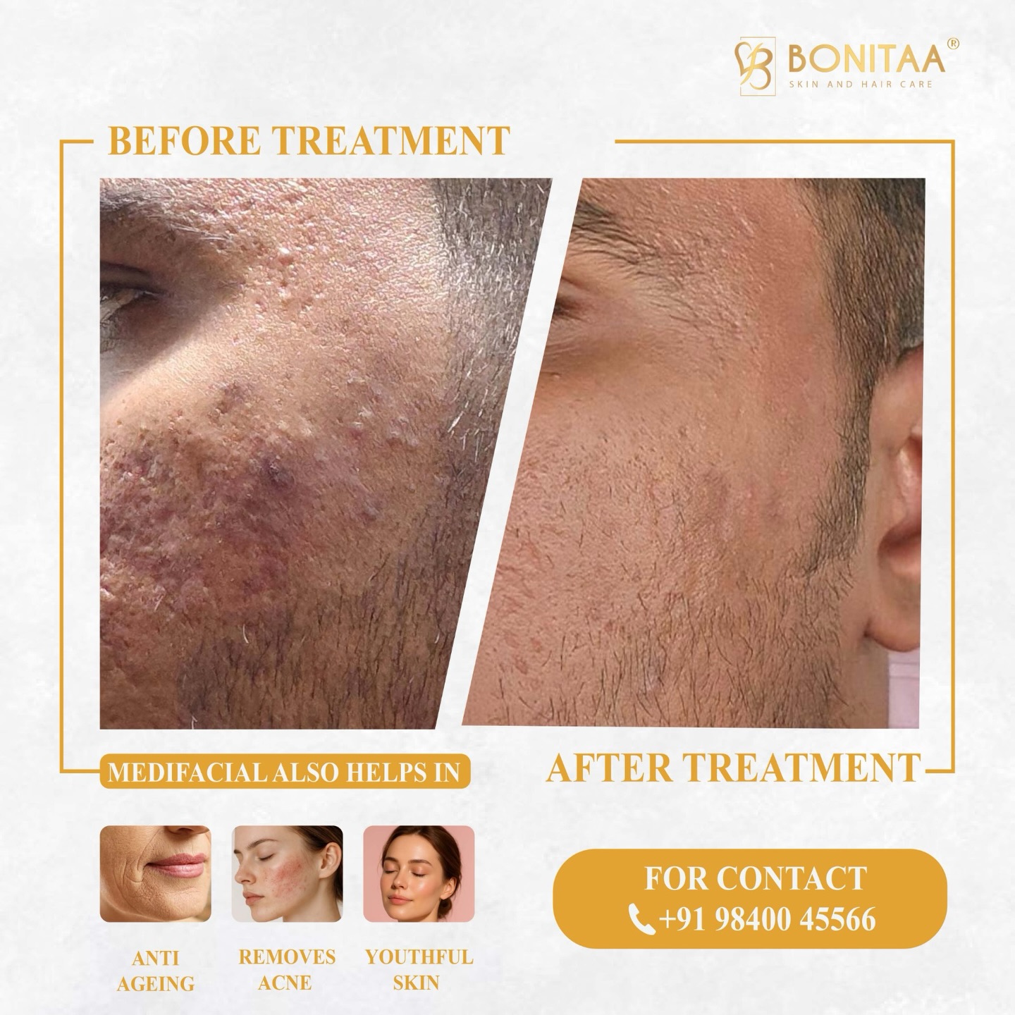 Bonitaa Skin & Haircare Erode Facebook ad: Struggling with acne scars, pigmentation & uneven skin…