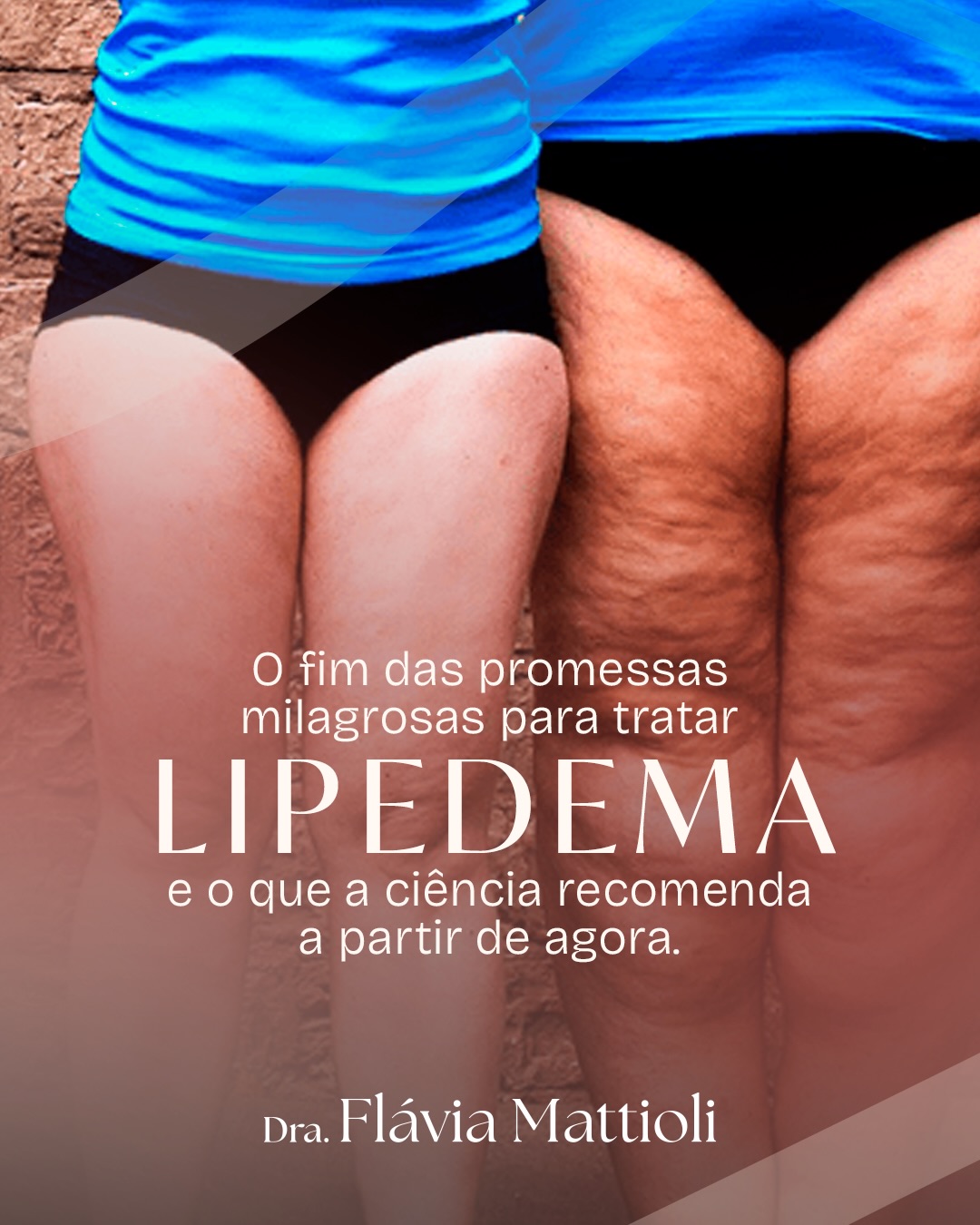 Dra. Flávia Mattioli - Medicina Integrativa e Lipedema Facebook ad: Durante anos, o lipedema foi cercado de mitos…