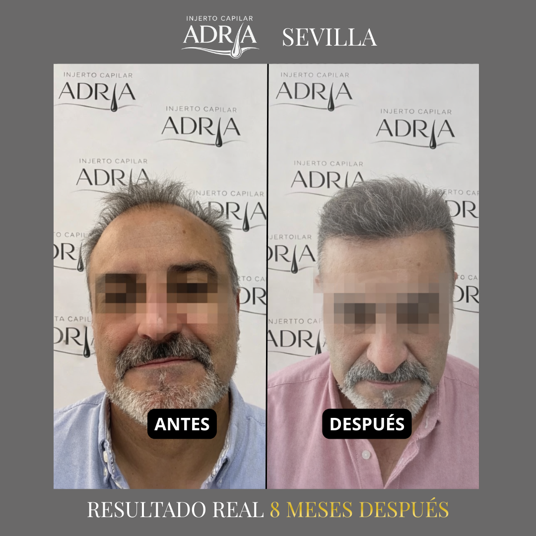 Injerto Capilar Adria Facebook ad