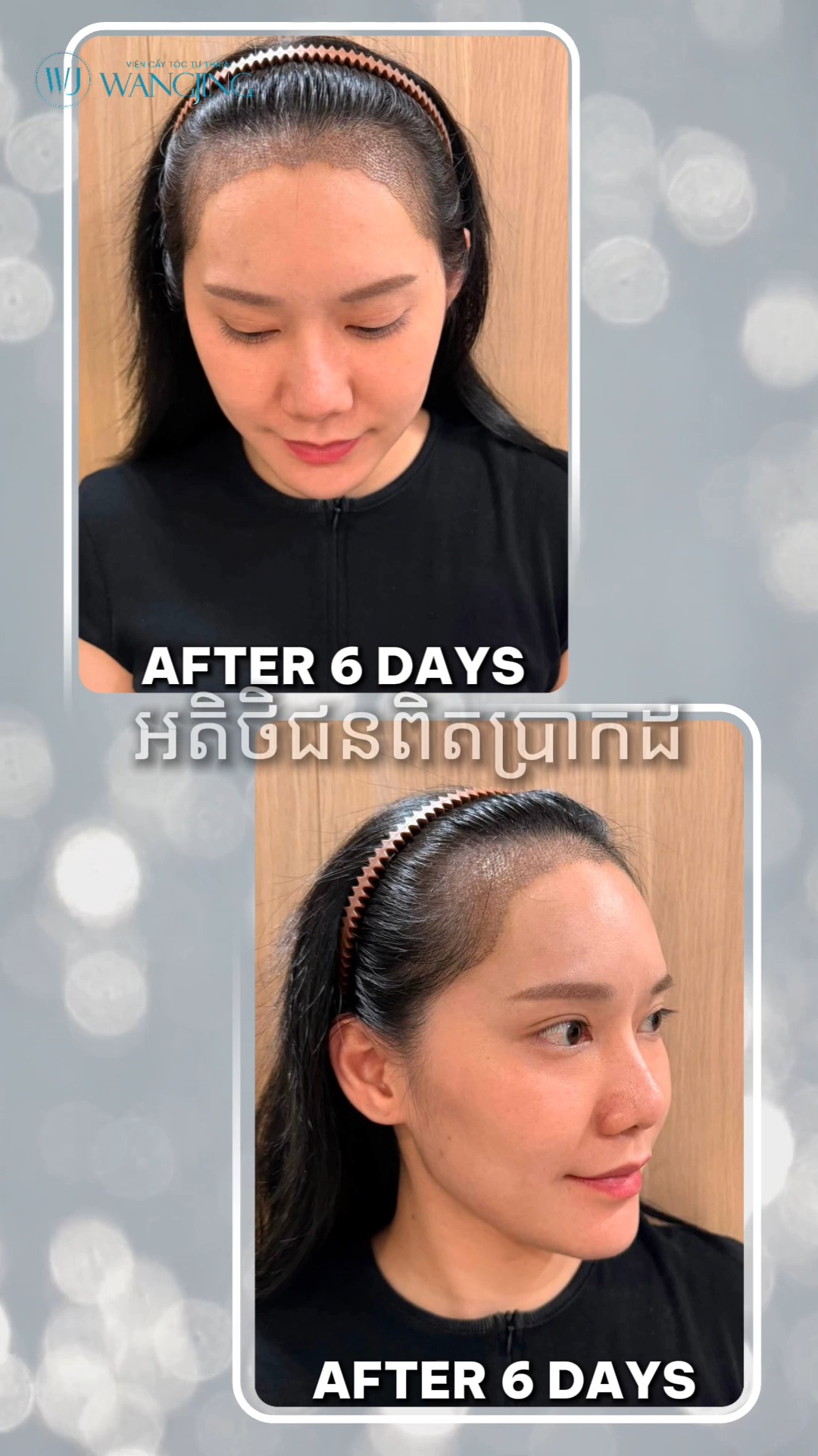 Viện Cấy Tóc Tự Thân WangJing DNA BioHair Facebook ad: |English Below|