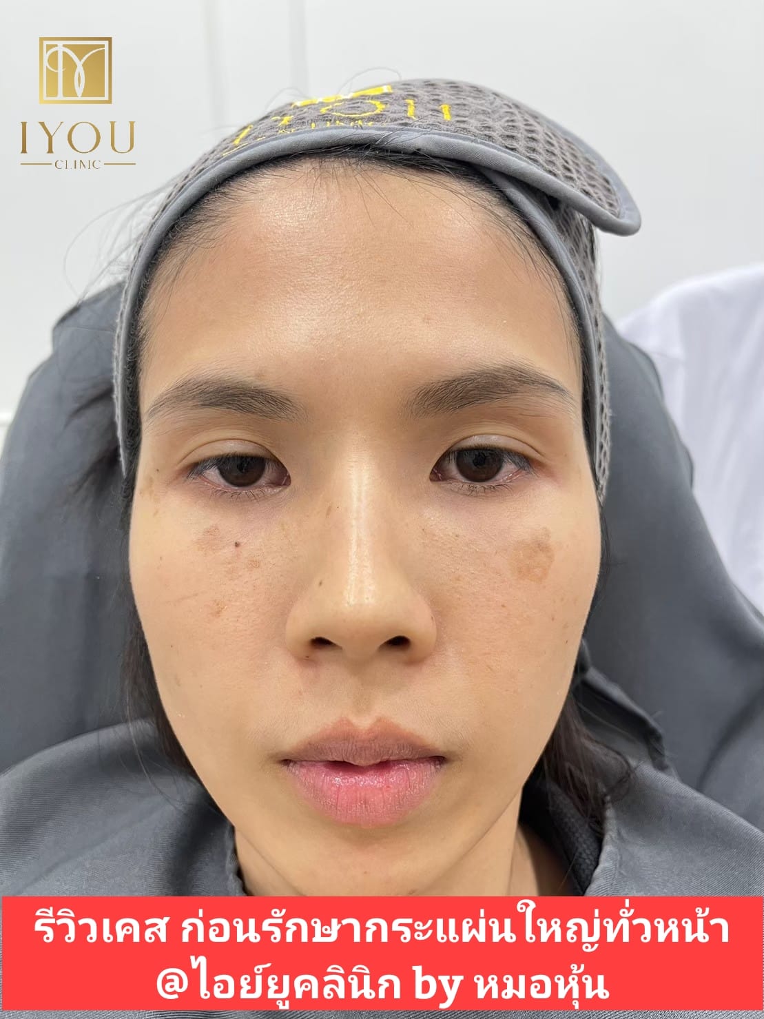IYOU Clinic ไอย์ยูคลินิก ฉะเชิงเทรา by หมอหุ้น Facebook ad