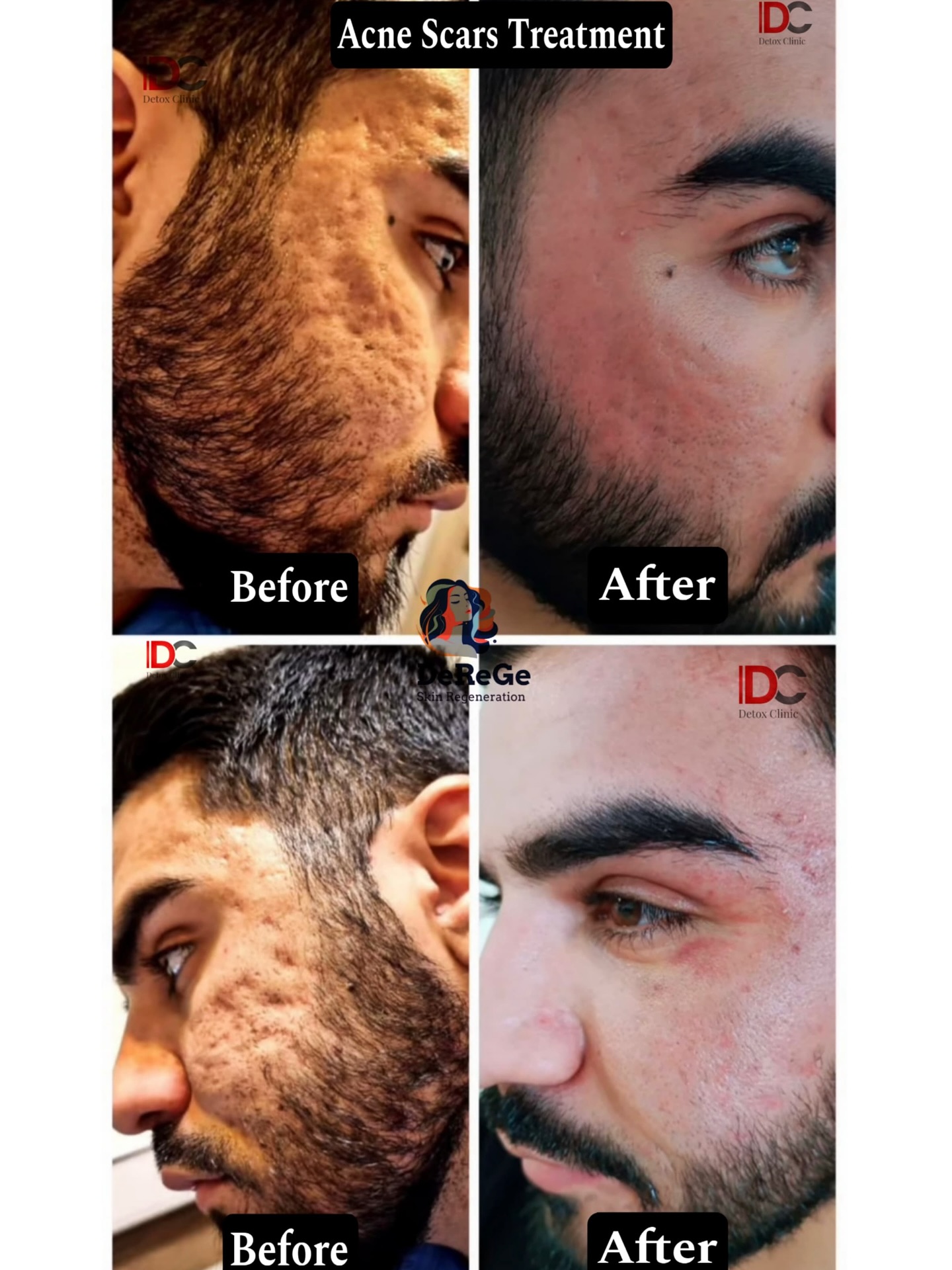 Detox Clinic Facebook ad: Successful Results Of Acne Scars By DeGeRe Treatment