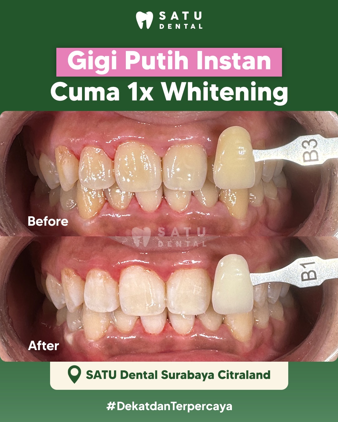 Satu Dental Surabaya Facebook ad: Gak perlu bingung kalau mau gigi putih instan