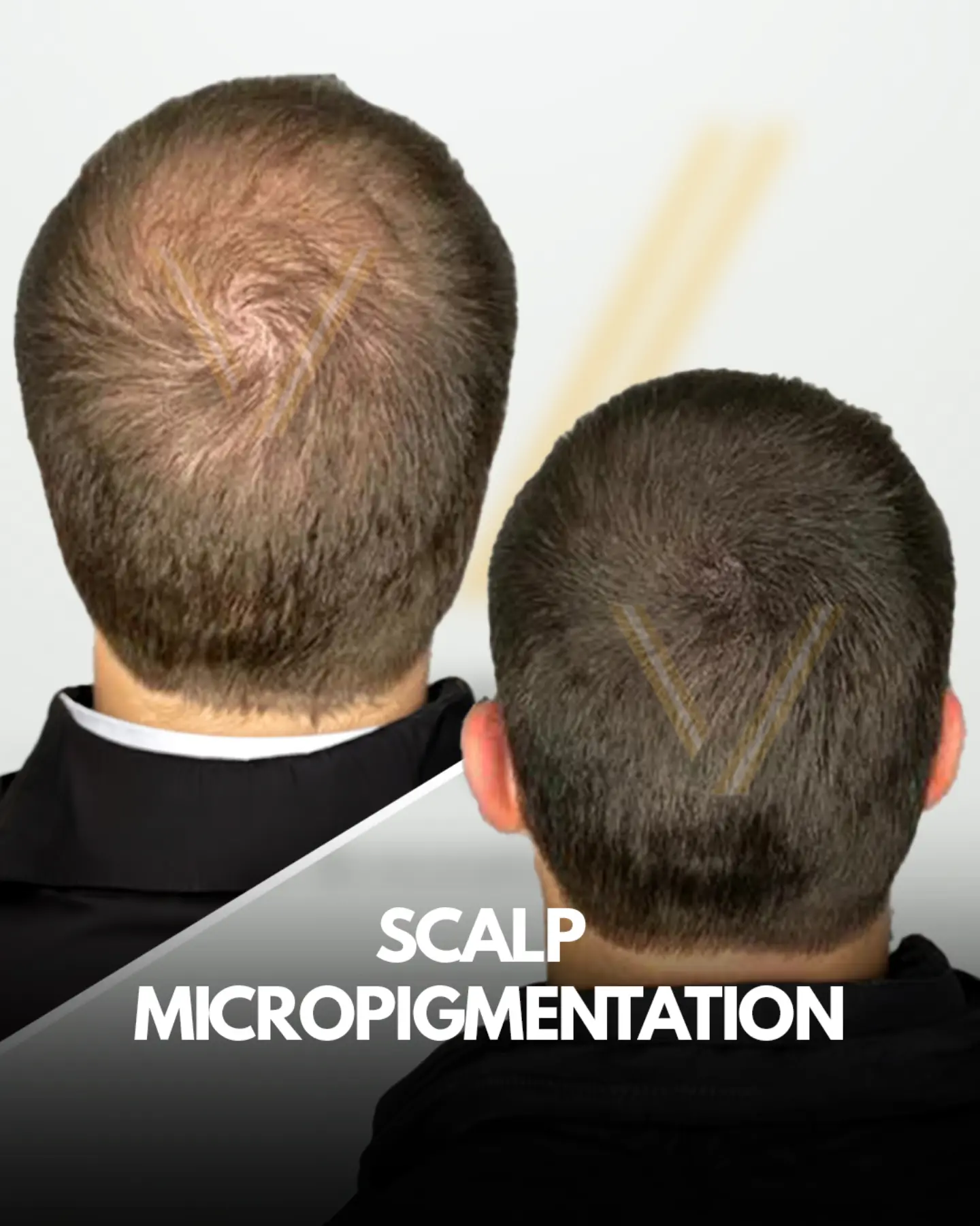 Vantage Hair Clinic Facebook ad: Saç Yoğunluğunuzu Ameliyatsız Artırın
