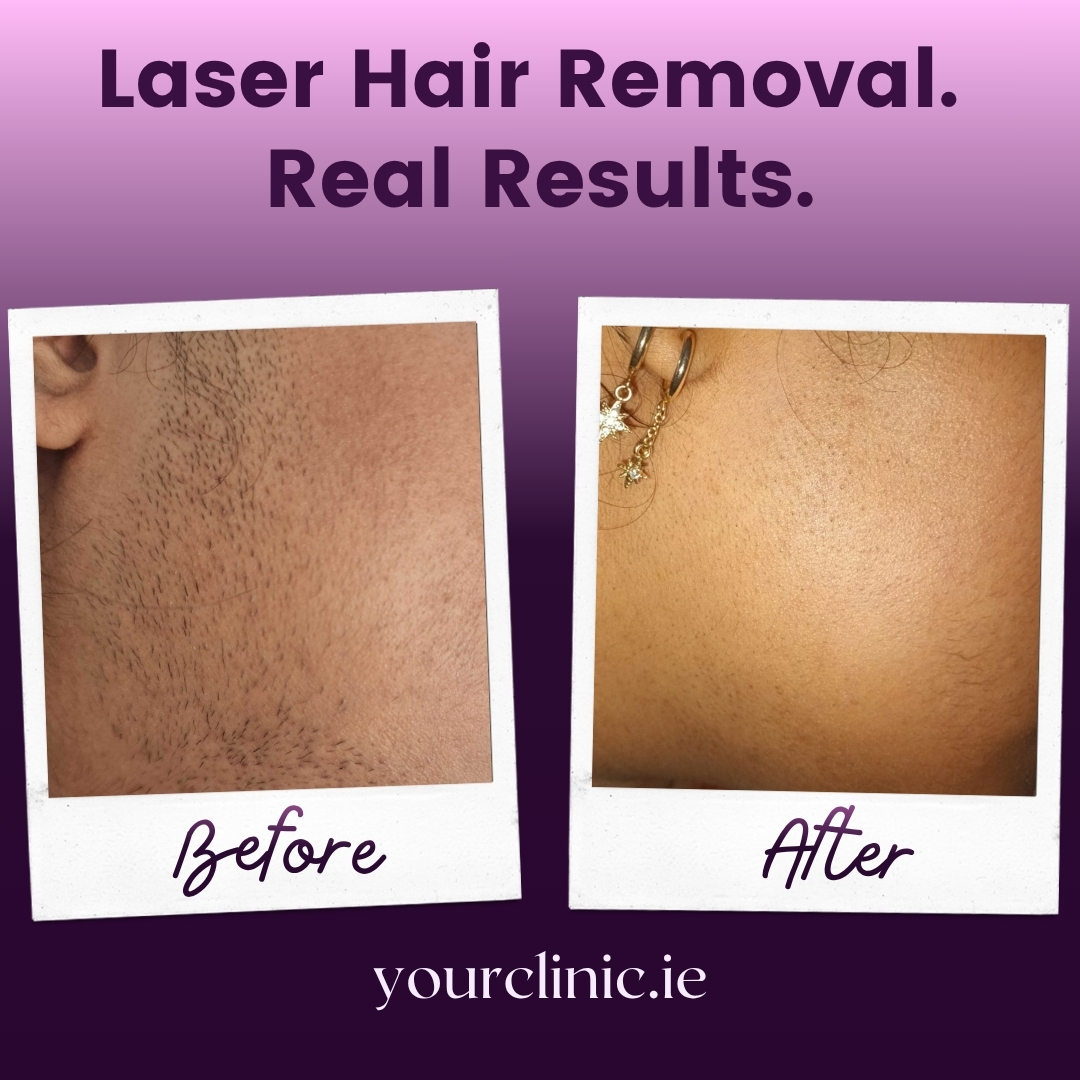 Your Clinic Facebook ad: Tired of constant shaving or waxing?
