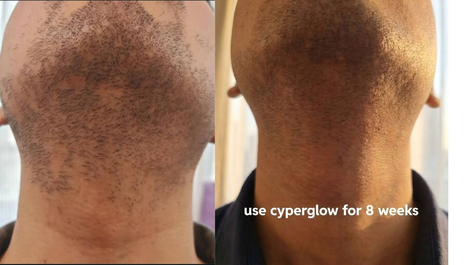 Stacy Lynn Facebook ad: Read this before you spend on laser. I stop my hair from…