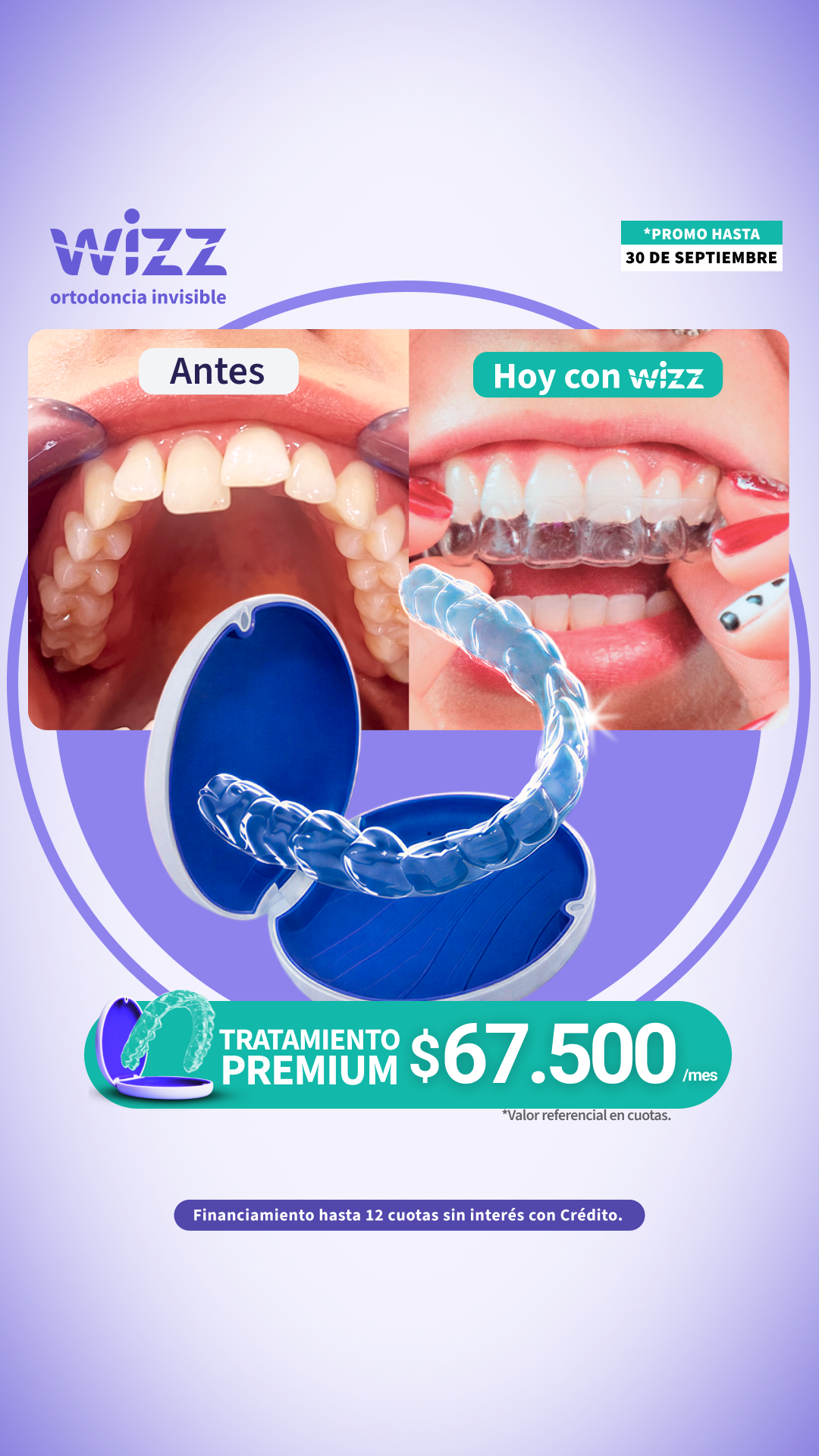 Wizz Chile Facebook ad: Corrige tu sonrisa con alineadores invisibles guiados por…
