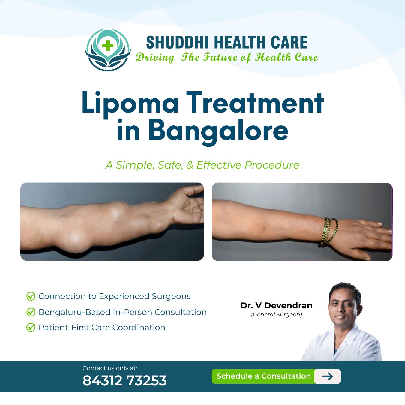 Shuddhi Healthcare Facebook ad: Lipoma Treatment available in Bengaluru