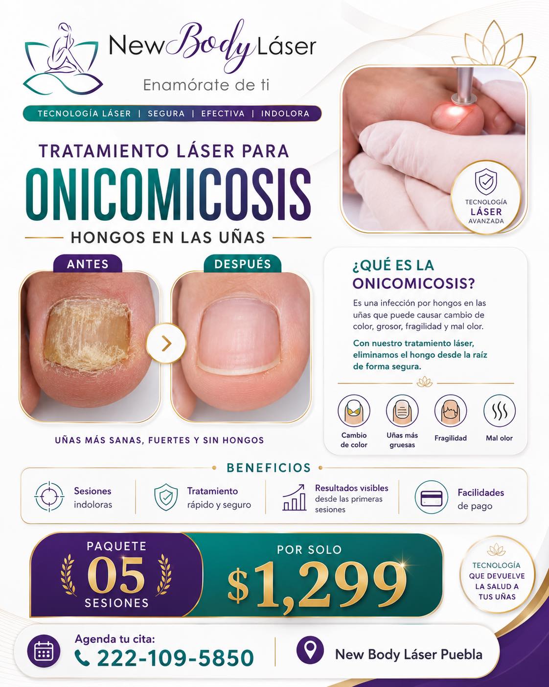 New Body Láser Puebla Facebook ad: ¿Hongos en las uñas?