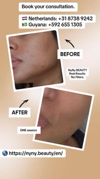 NyNy Beauty Facebook ad: MICRONEEDLING