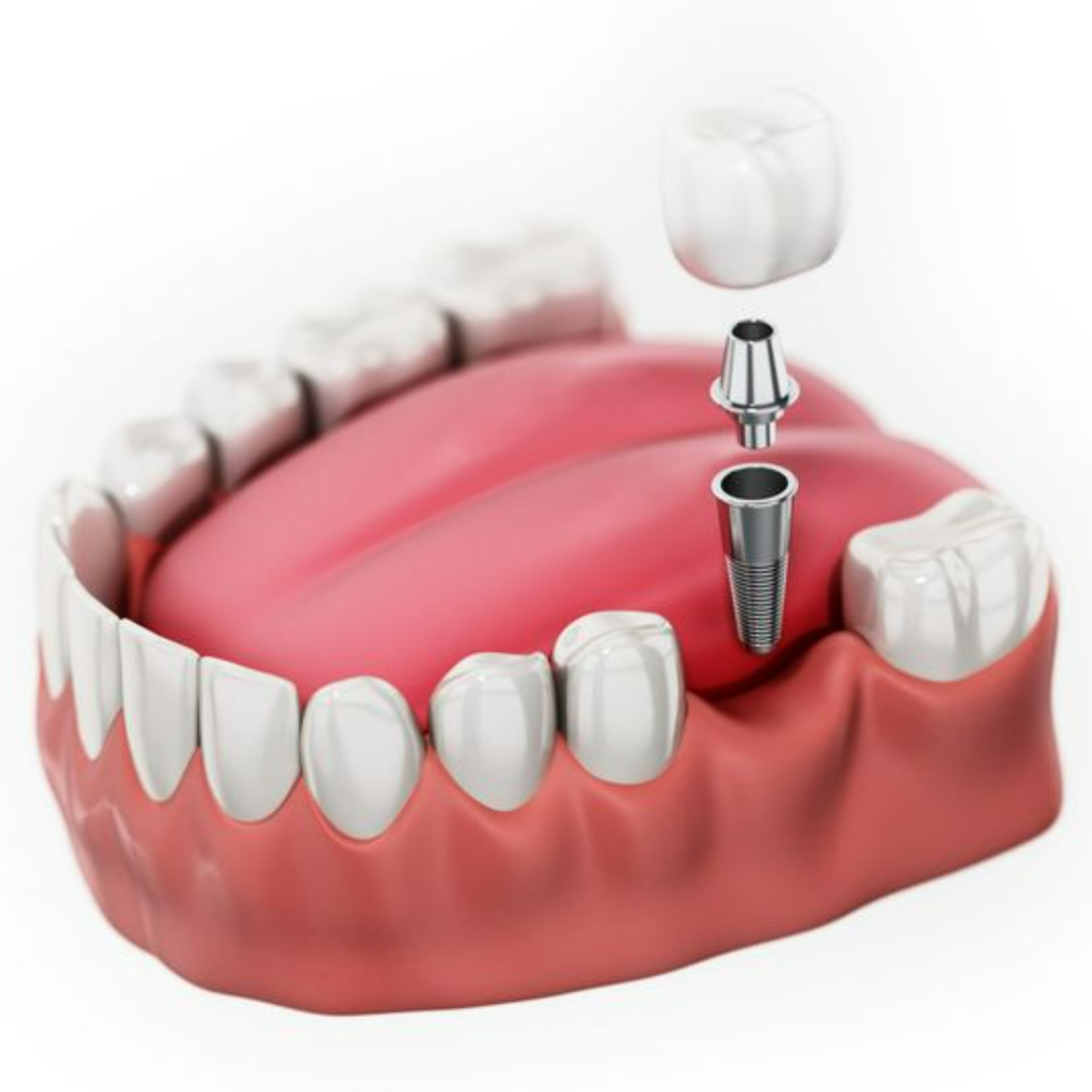 Dental Views Facebook ad: Single Dental Implants As Low As $999