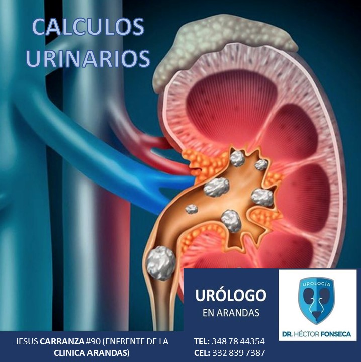 Urologo en Arandas Facebook ad: CÁLCULOS URINARIOS