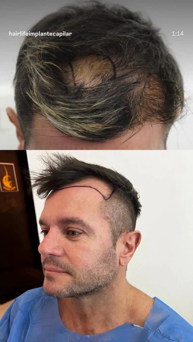 Hair Life Implante Capilar Facebook ad: Chatea con nosotros