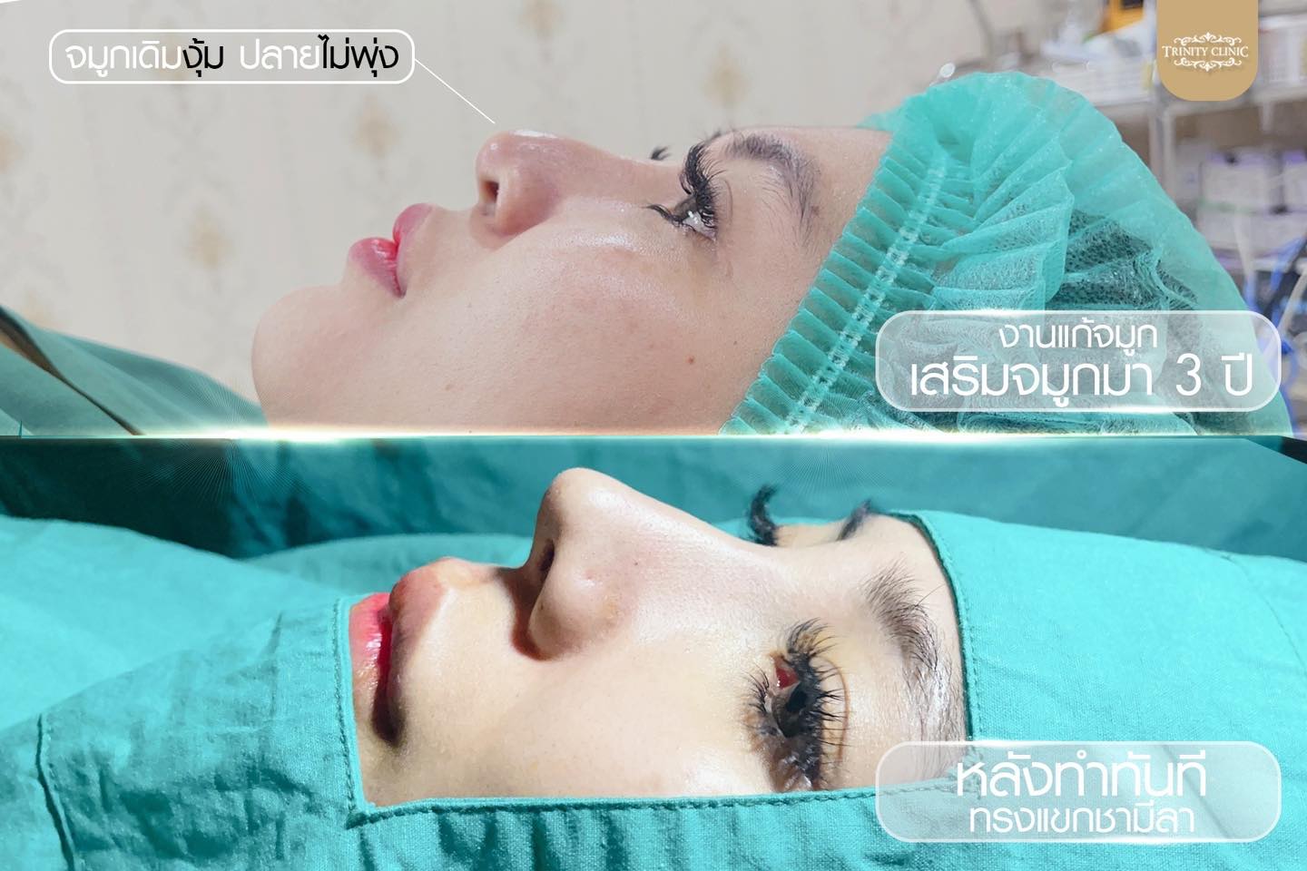 Trinity Clinic ทรินิตี้ คลินิก เสริมจมูก เสริมคาง Facebook ad