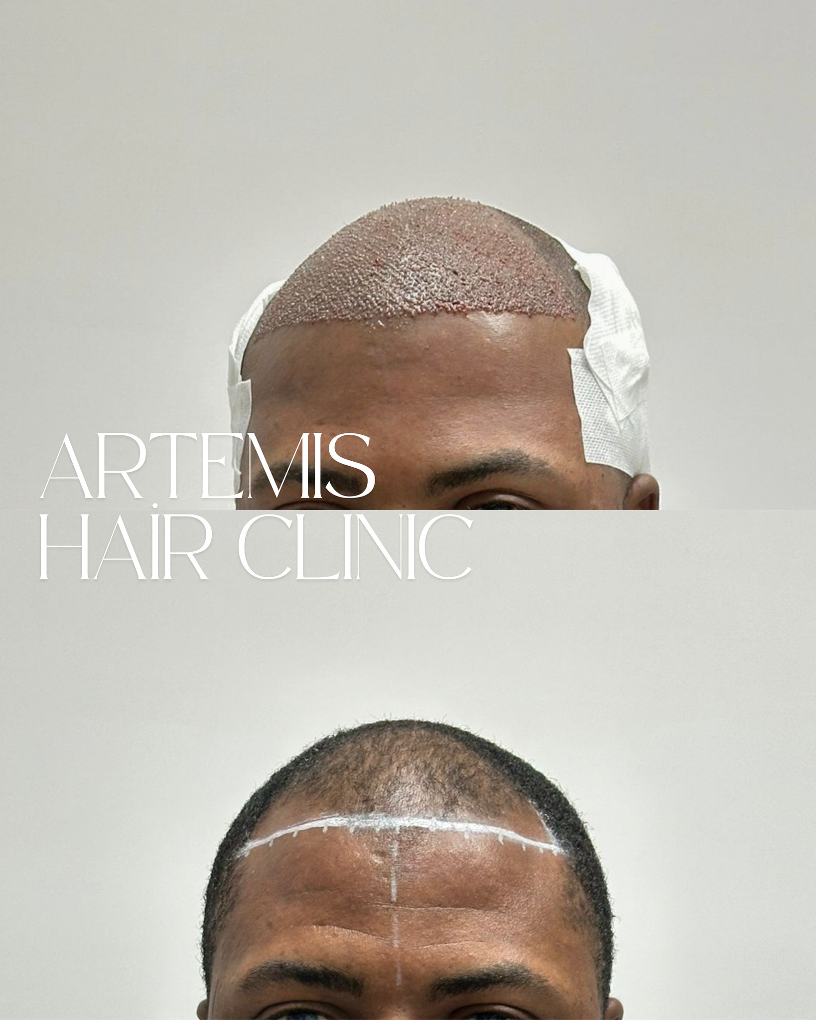 Artemis Hair Clinic Facebook ad: Haarausfall ist kein Schicksal.