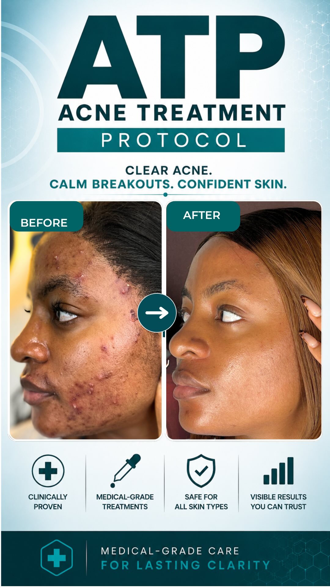 Bregha Beauty Brand Facebook ad: A lot of acne returns because the full…