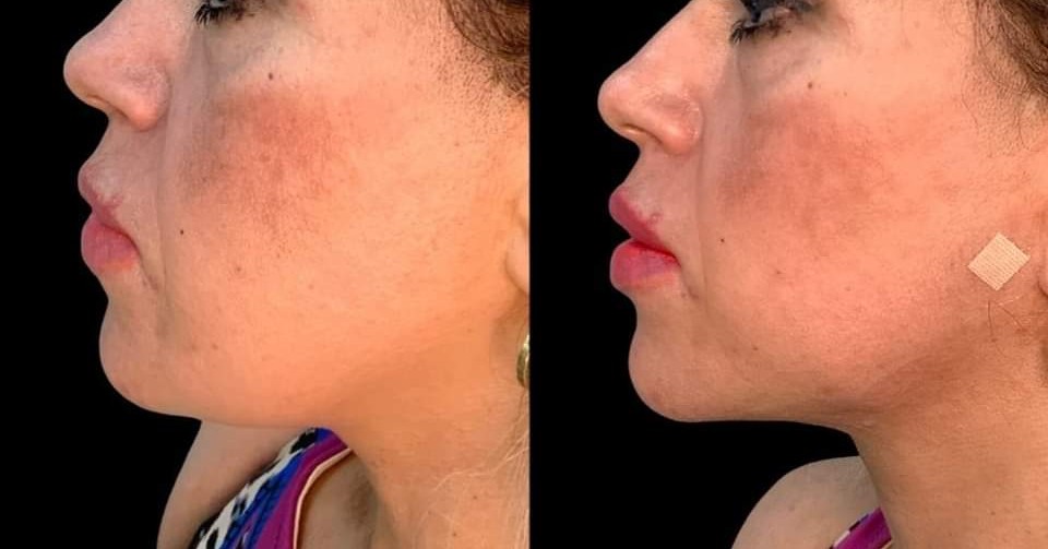 D'vine Beauty Clinic Facebook ad: Botox | D'vine Beauty Clinic | Mcallen