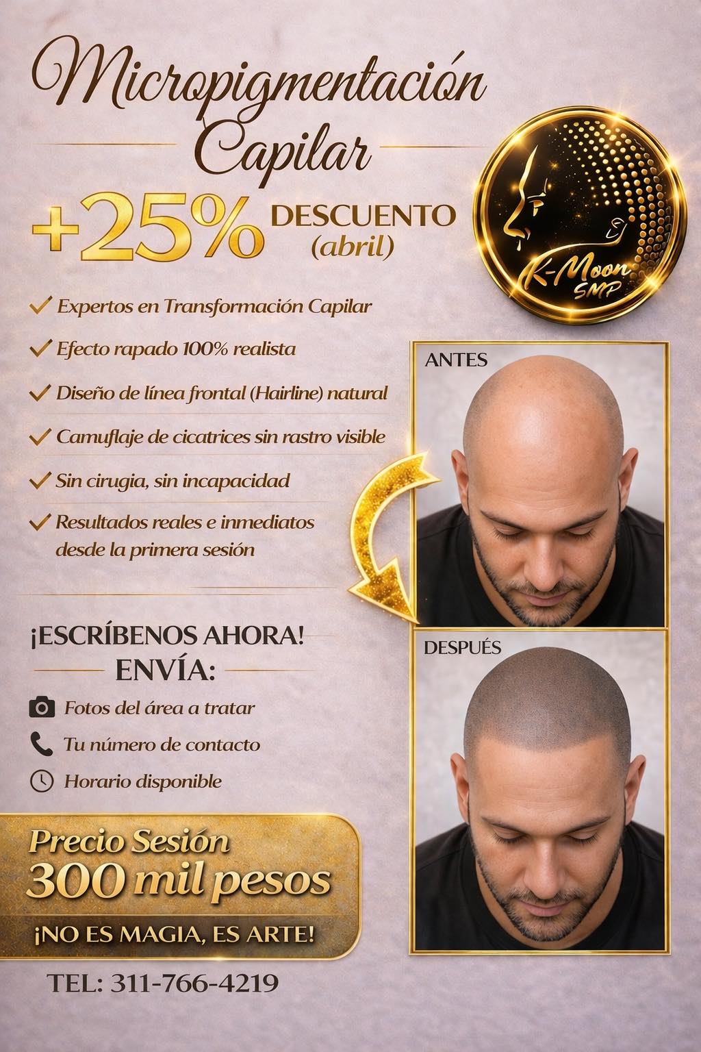 KMOON SMP Facebook ad: SOLUCIÓN # 1 - CONTRA LA CALVICIE