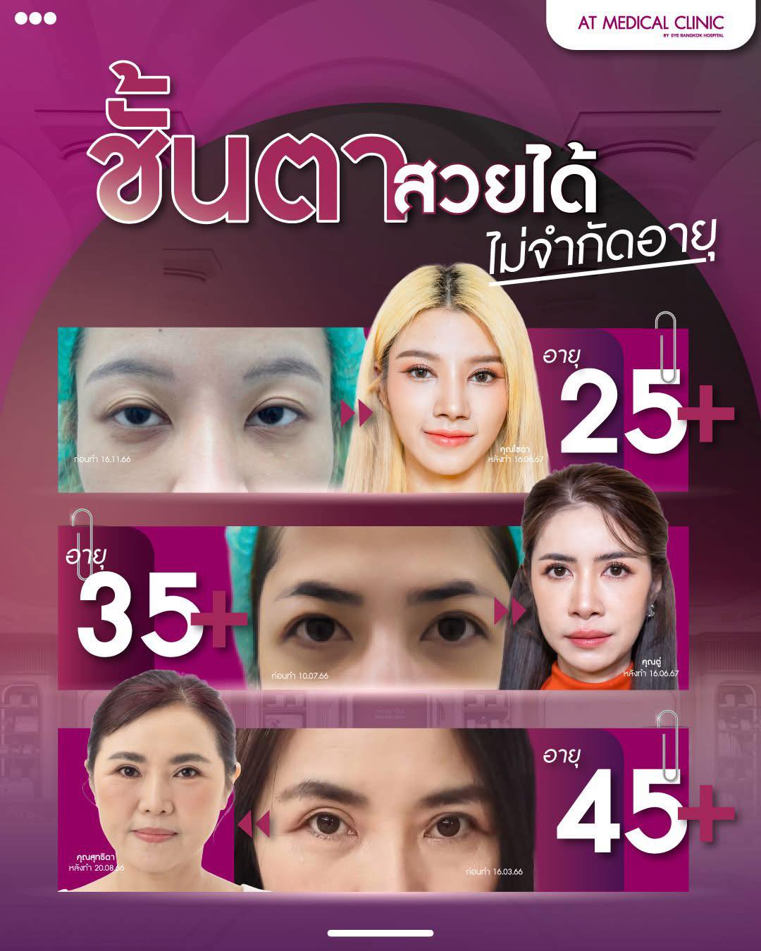 ตาสองชั้นหมอไก่ At medical clinic By. เฟเน่ Facebook ad: ชั้นตาสวยได้…ไม่จำกัดอายุ